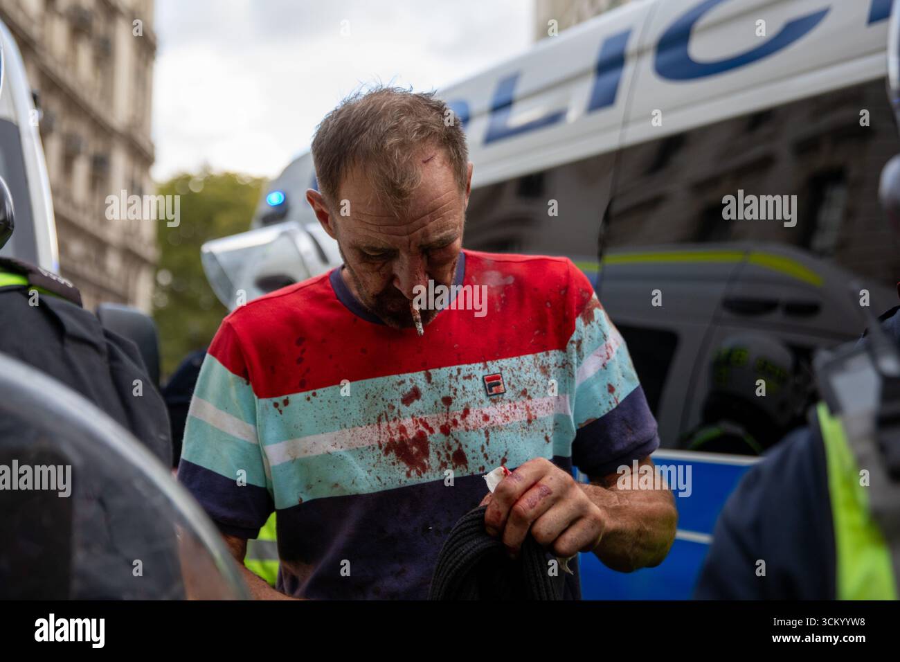 Un homme blessé fume une cigarette lors d'une manifestation. Le rassemblement de mars Unite the Kingdom London organisé le 13 septembre 2025 a attiré des milliers de participants. Cet événement a été organisé par le militant politique Stephen Yaxley-Lennon, également connu sous le nom de Tommy Robinson, qui a précédemment dirigé des manifestations similaires axées sur les questions d'immigration et d'intégration sociale. Le calendrier du rassemblement coïncide avec les débats nationaux en cours sur les contrôles aux frontières, la cohésion communautaire et la montée de l'islam radical. (Photo de James Willoughby/SOPA images/Sipa USA) Banque D'Images