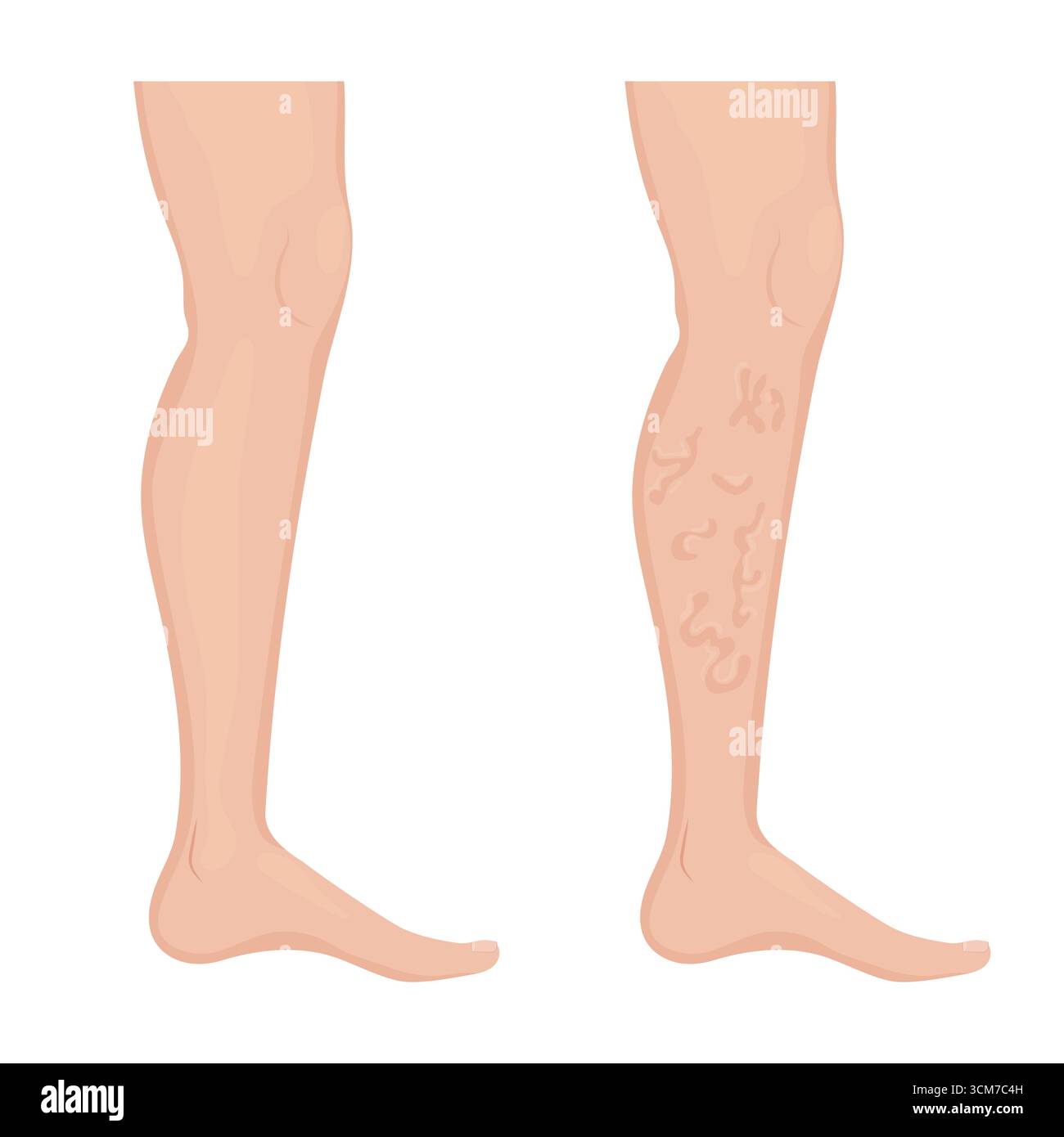 Comparaison de la jambe saine avec les varices, montrant le développement de la maladie vasculaire Illustration de Vecteur