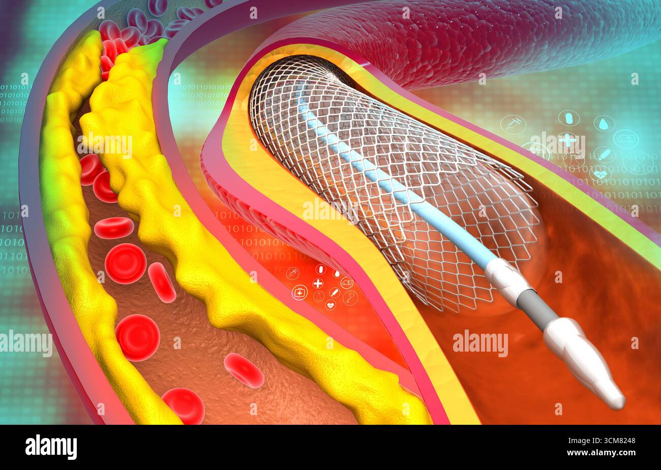 Stent pour artère coronaire. Artères bouchées. illustration 3d. Banque D'Images