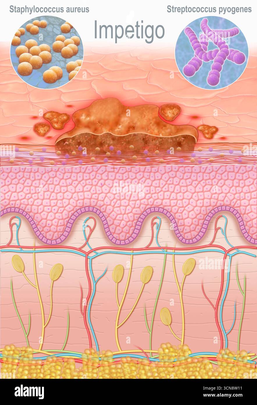 Illustration d'une peau croûtée causée par l'impétigo, une infection bactérienne de la peau causée par des bactéries telles que Staphylococcus aureus et Streptococcus pyogenes. Elle est très contagieuse et touche principalement les enfants. Elle se caractérise par la formation de cloques ou de plaies croustillantes sur la peau. Banque D'Images