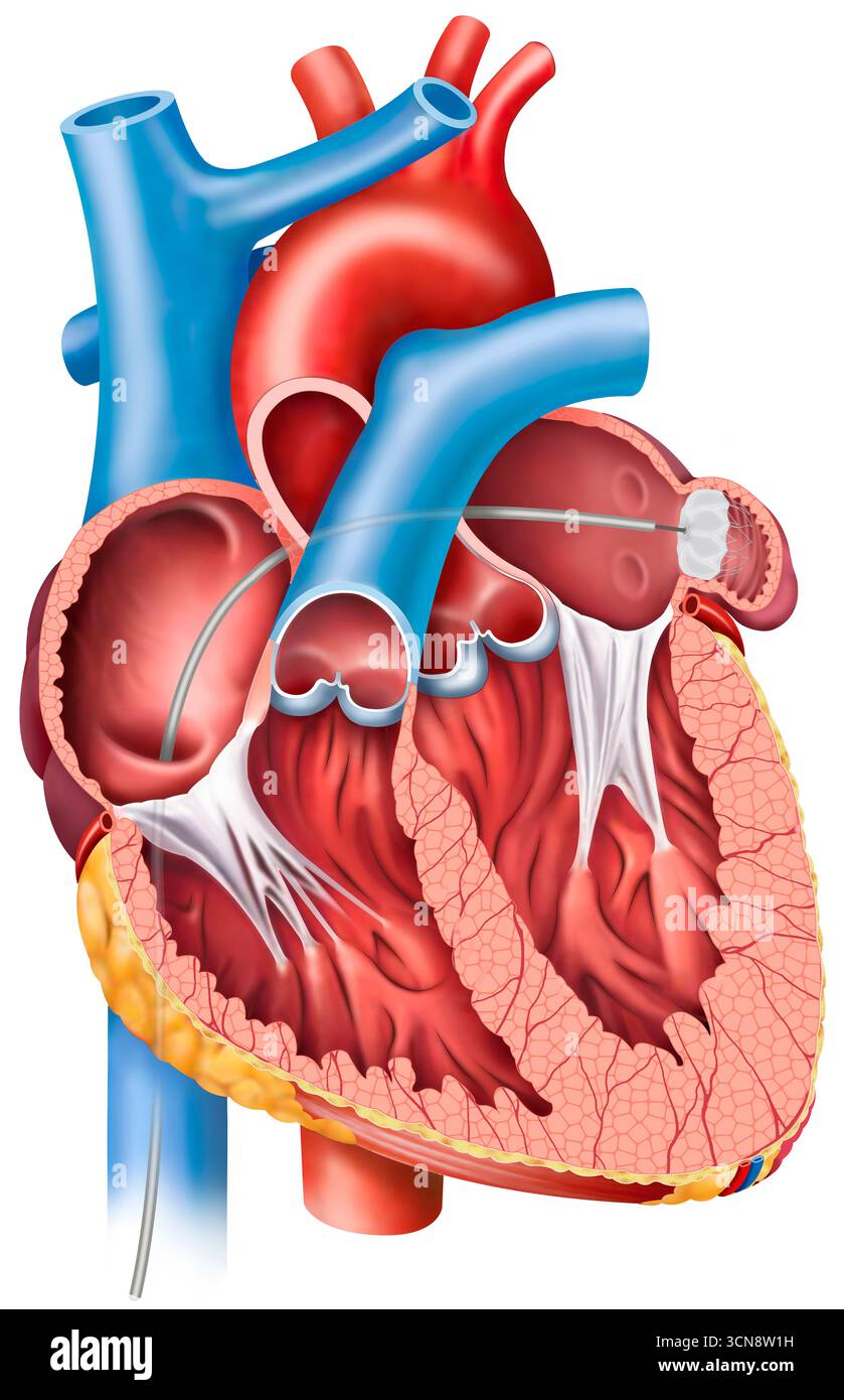 Illustration d'une coupe sagittale du cœur mettant en évidence l'appendice auriculaire gauche. C'est un petit sac de forme irrégulière situé sur le côté gauche. On pense que ce petit sac, sujet à la formation de caillots sanguins, bien que sa fonction ne soit pas entièrement comprise, influence l'efficacité de la contraction auriculaire. Banque D'Images