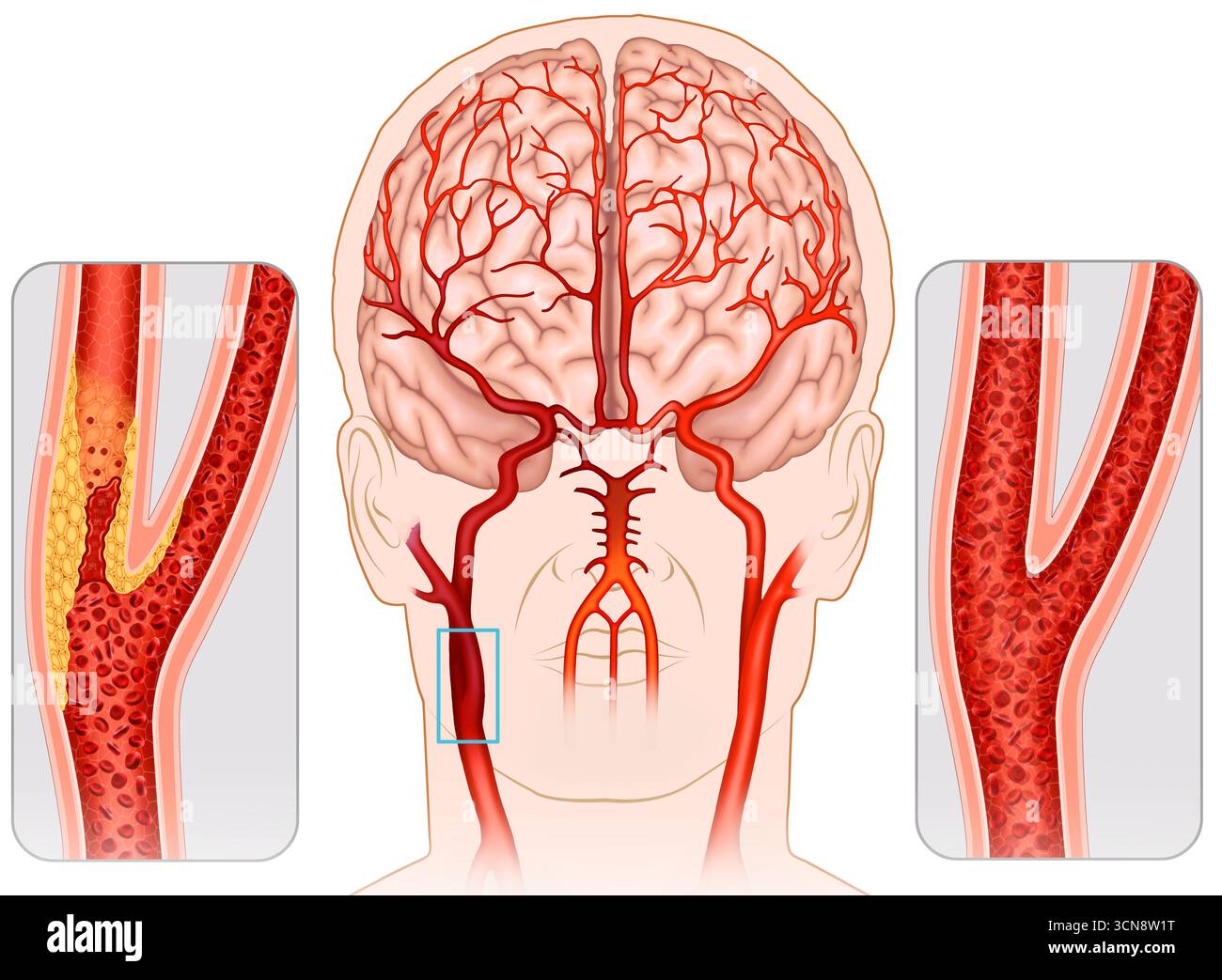 Illustration d'une tête humaine, avec une artère carotide ramifiée. Ceci montre l'athérosclérose, qui subit un rétrécissement dû à l'accumulation de graisse et de cholestérol dans ses parois. Cela réduit l'élasticité artérielle, compromet la circulation sanguine et augmente le risque de maladie cardiovasculaire. Banque D'Images