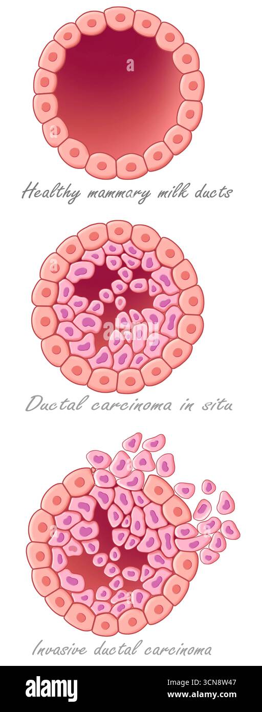 Illustration montrant la section frontale de ces lobes. Dans le premier exemple, nous avons un lobe sain ; dans le second, un cas de carcinome in situ, qui implique des cellules cancéreuses confinées à leur site d'origine. Dans le troisième exemple, nous avons le carcinome invasif, qui implique l'invasion des tissus environnants. Banque D'Images