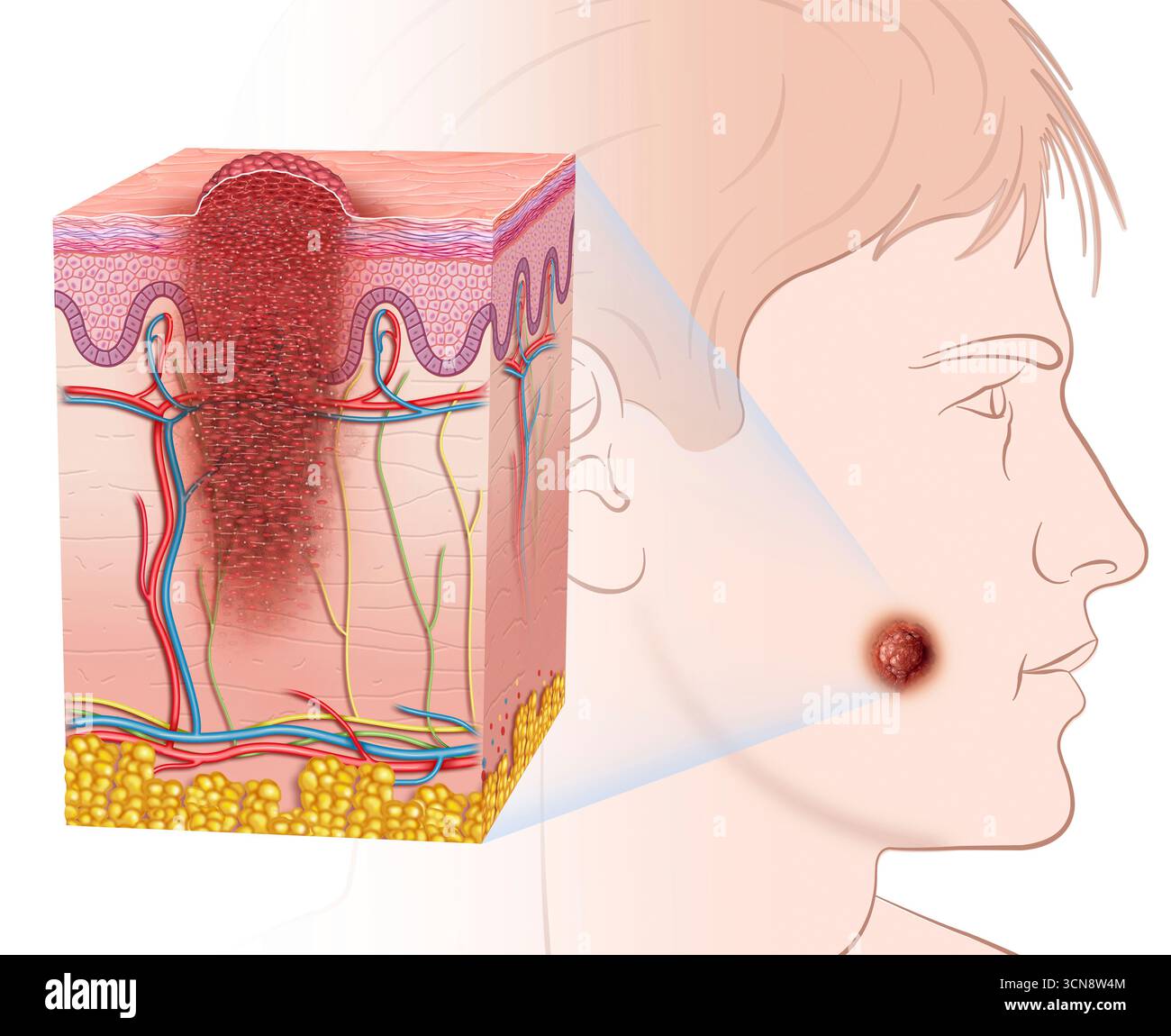 Illustration d'un visage de profil montrant un mélanome. Le mélanome dans les zones exposées au soleil est une préoccupation croissante. L'exposition aux rayons ultraviolets (UV) du soleil est un facteur de risque majeur pour le développement du mélanome et le visage est l'une des zones les plus fréquemment touchées en raison de son exposition continue. Banque D'Images