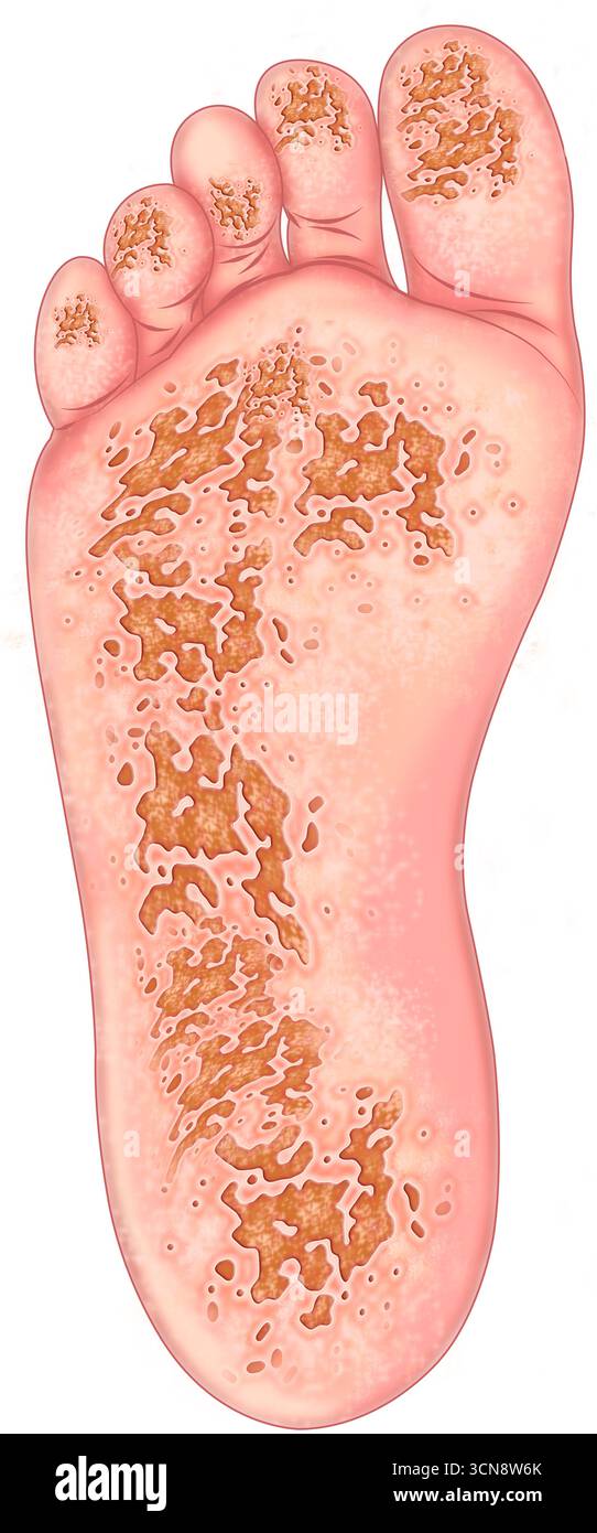 Illustration de la plante d'un pied atteinte d'arthrite réactionnelle. Cela peut se manifester par des éruptions cutanées, des ulcères ou des plaques ressemblant au psoriasis ou à l'eczéma et peut apparaître sur les paumes des mains et la plante des pieds. Cette maladie se développe parfois après une infection ailleurs dans le corps. Banque D'Images Illustration de la plante d'un pied atteinte d'arthrite réactionnelle. Cela peut se manifester par des éruptions cutanées, des ulcères ou des plaques ressemblant au psoriasis ou à l'eczéma et peut apparaître sur les paumes des mains et la plante des pieds. Cette maladie se développe parfois après une infection ailleurs dans le corps. Banque D'Images