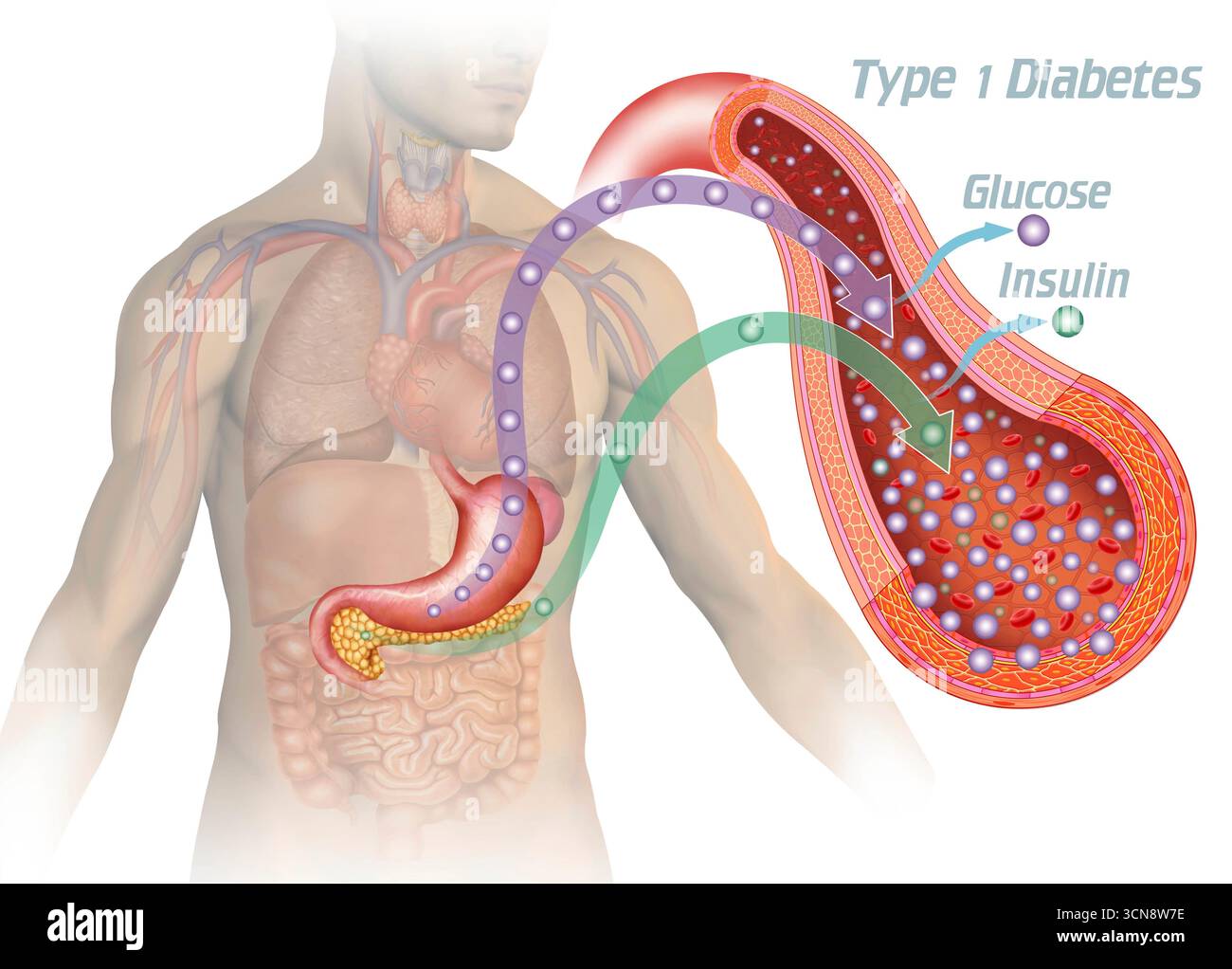 Illustration d'une représentation humaine sur fond bleu montrant une artère et la circulation sanguine. Il y a une carence en insuline avec une augmentation du glucose. Dans le diabète de type 1, le système immunitaire détruit les cellules bêta du pancréas, empêchant ainsi la production d’insuline. Sans cette hormone, le glucose ne peut pas pénétrer dans les cellules et s'accumule dans le sang. Banque D'Images