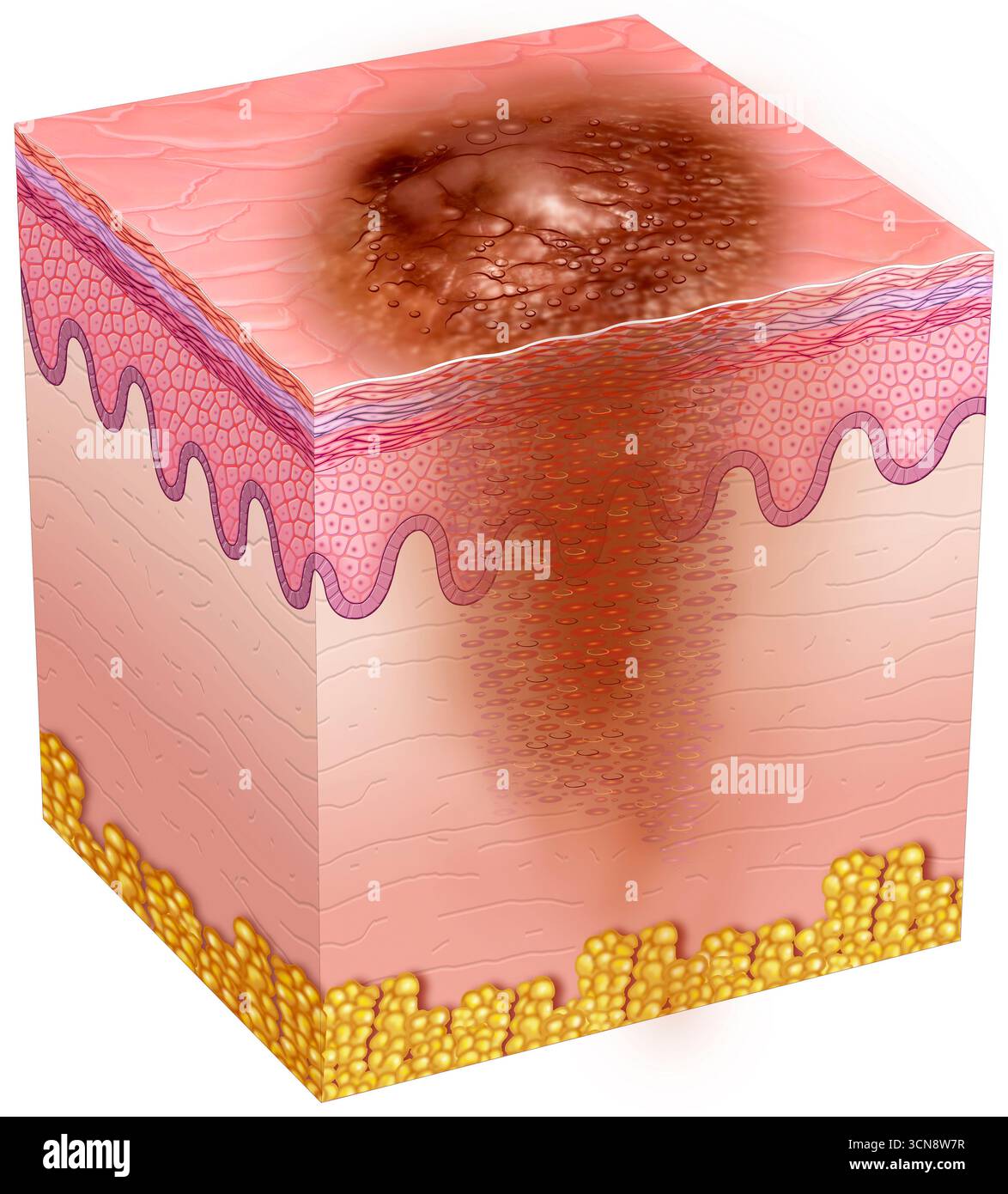 Illustration d'une peau avec carcinome épidermoïde. Cette tumeur maligne de la peau trouve son origine dans les cellules de la couche externe de l'épiderme, qui sont fréquemment exposées au soleil. Il apparaît généralement comme une tache rougeâtre et écailleuse ou une bosse qui ne guérit pas, ou comme un ulcère qui saigne et peut se développer. Une exposition prolongée aux rayons UV en est la cause principale. Banque D'Images