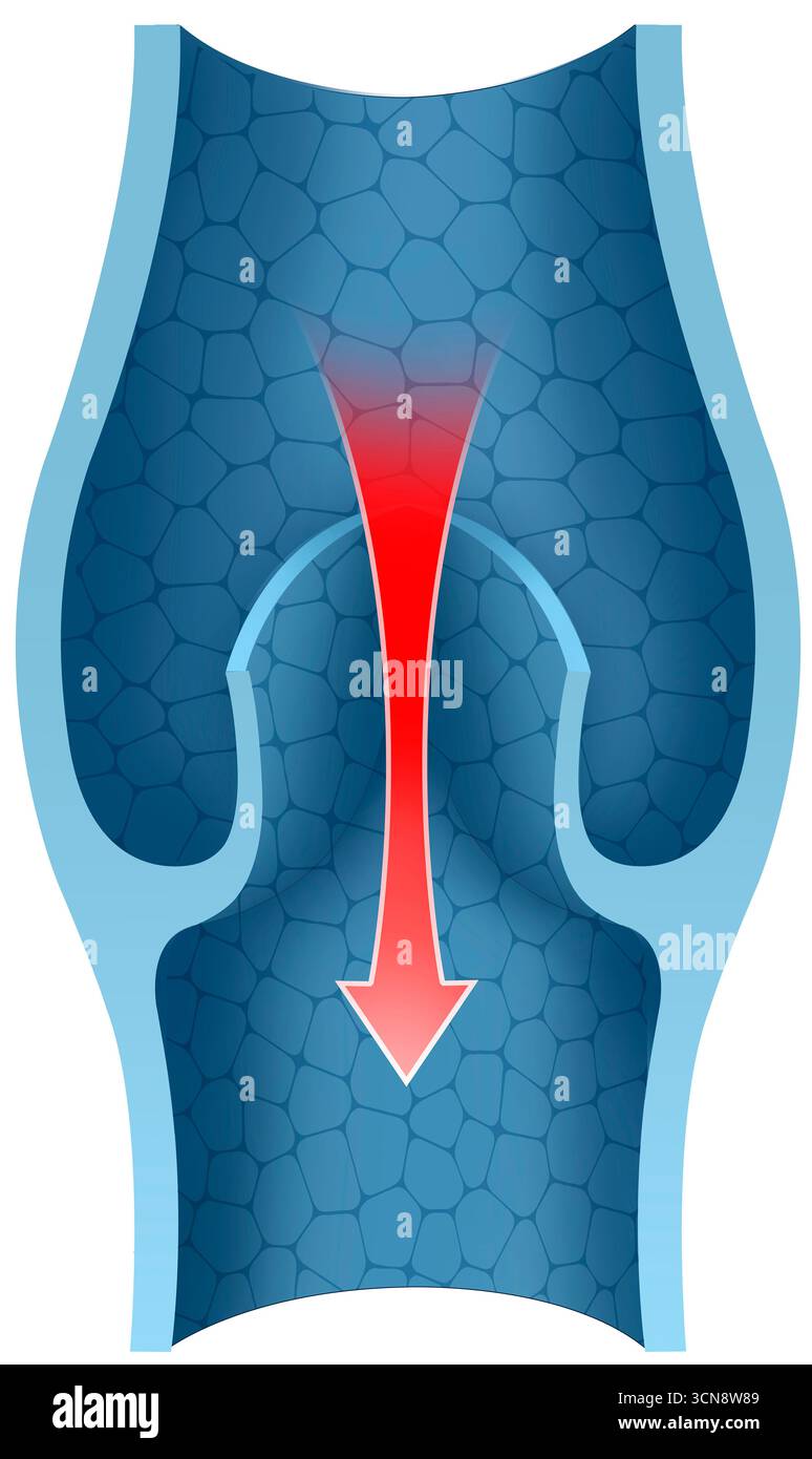 Illustration montrant une veine avec une valvule variqueuse. Cet état de valve permet le reflux sanguin et empêche le retour veineux au cœur. Les valves veineuses endommagées ne se ferment pas correctement, provoquant une accumulation de sang, une dilatation des veines et l'apparition de varices. Banque D'Images