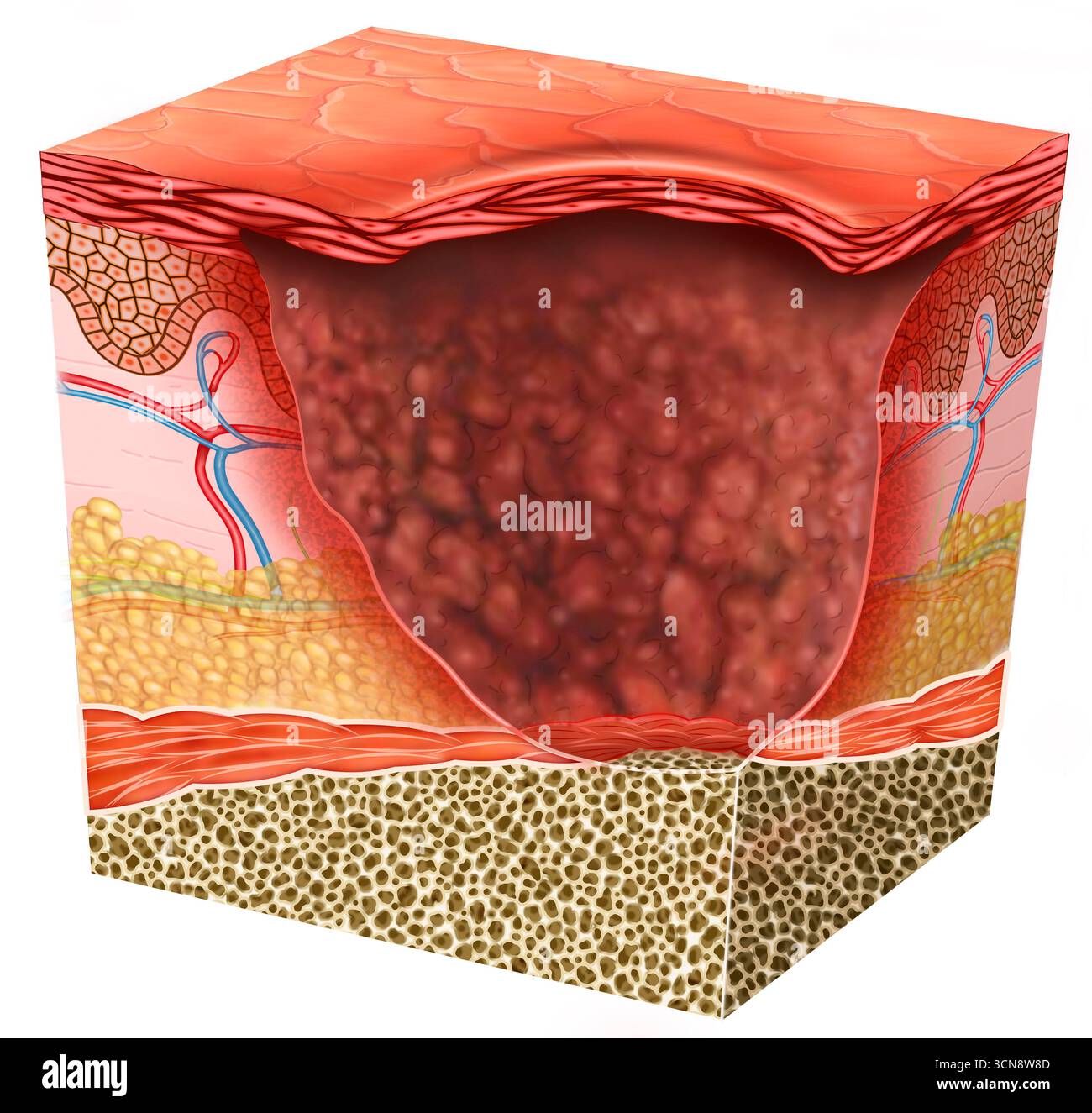 Illustration montrant une peau avec mélanome ulcéré sous la surface de la peau, un type de cancer de la peau qui présente une rupture dans la peau sus-jacente. Cette ulcération est un facteur important dans la classification du mélanome, car elle indique un risque de propagation plus élevé que le mélanome non ulcéré. Banque D'Images