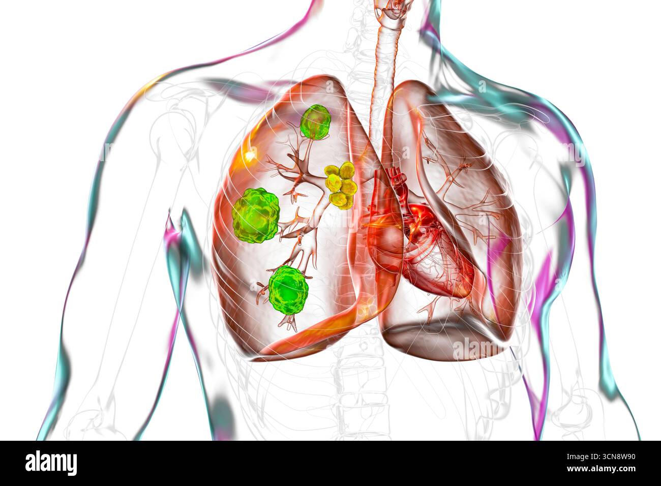 Illustration d'une blastomycose pulmonaire avec lésions pulmonaires et hypertrophie ganglionnaire bronchique. Banque D'Images