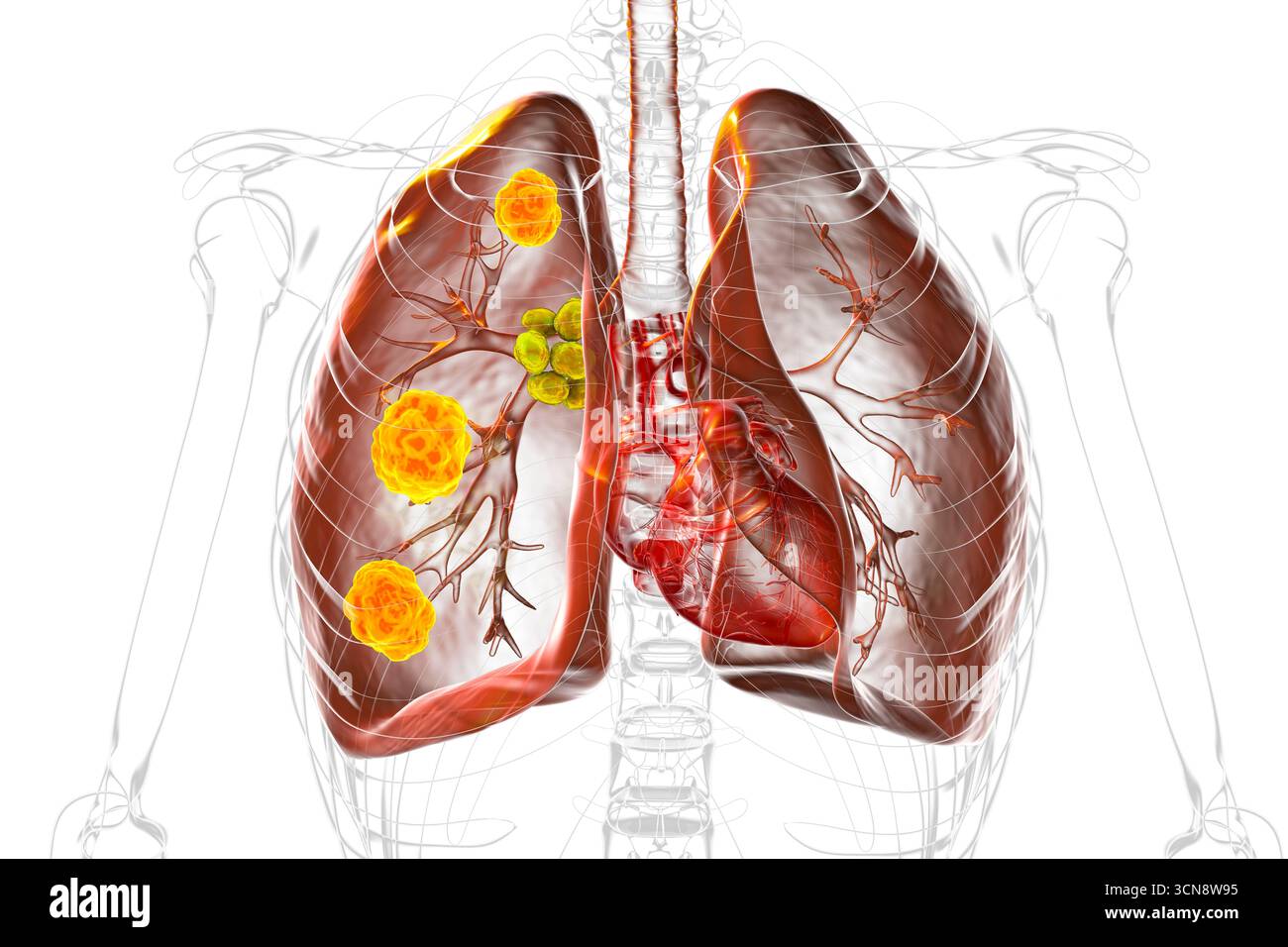 Illustration d'une blastomycose pulmonaire avec lésions pulmonaires et hypertrophie ganglionnaire bronchique. Banque D'Images