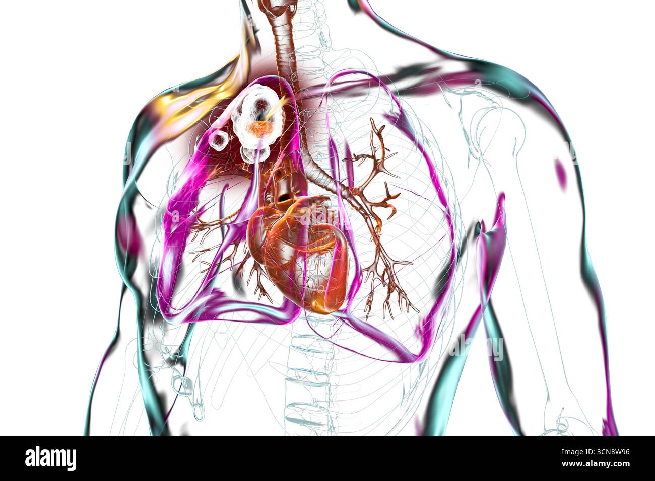 Tuberculose cavitaire dans le lobe supérieur du poumon droit. Illustration montrant des lésions pulmonaires et des cavités. Banque D'Images