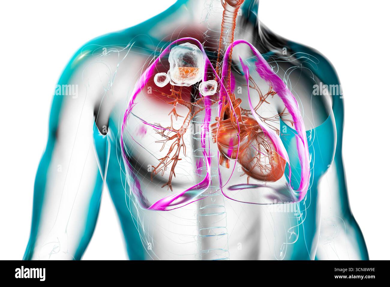 Tuberculose cavitaire dans le lobe supérieur du poumon droit. Illustration montrant des lésions pulmonaires et des cavités. Banque D'Images