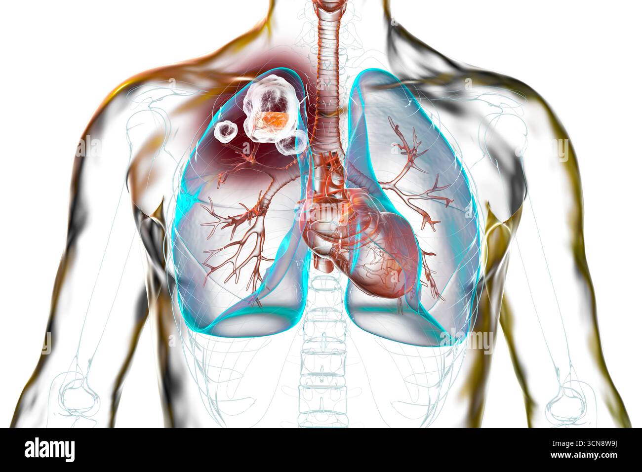 Tuberculose cavitaire dans le lobe supérieur du poumon droit. Illustration montrant des lésions pulmonaires et des cavités. Banque D'Images