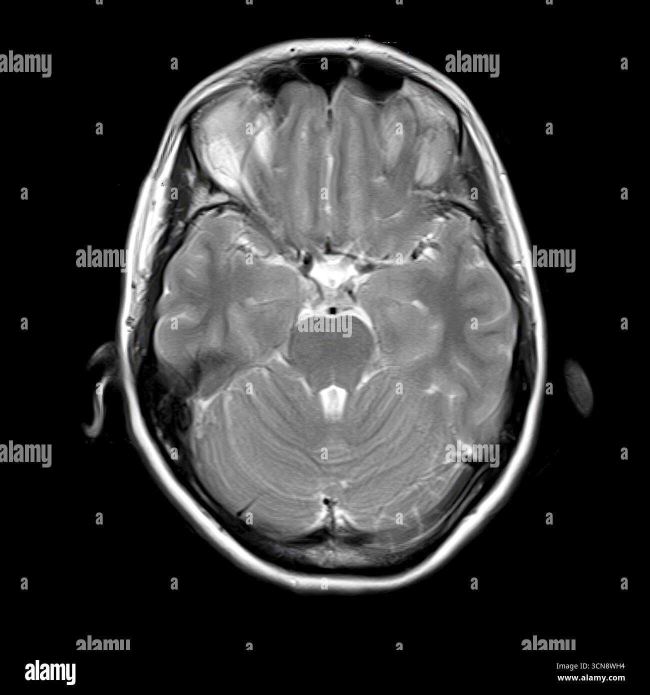 Imagerie par résonance magnétique (IRM) du cerveau humain au niveau inférieur du tronc cérébral, montrant Pons, medulla oblongata, cervelet et lobes temporaux. Banque D'Images