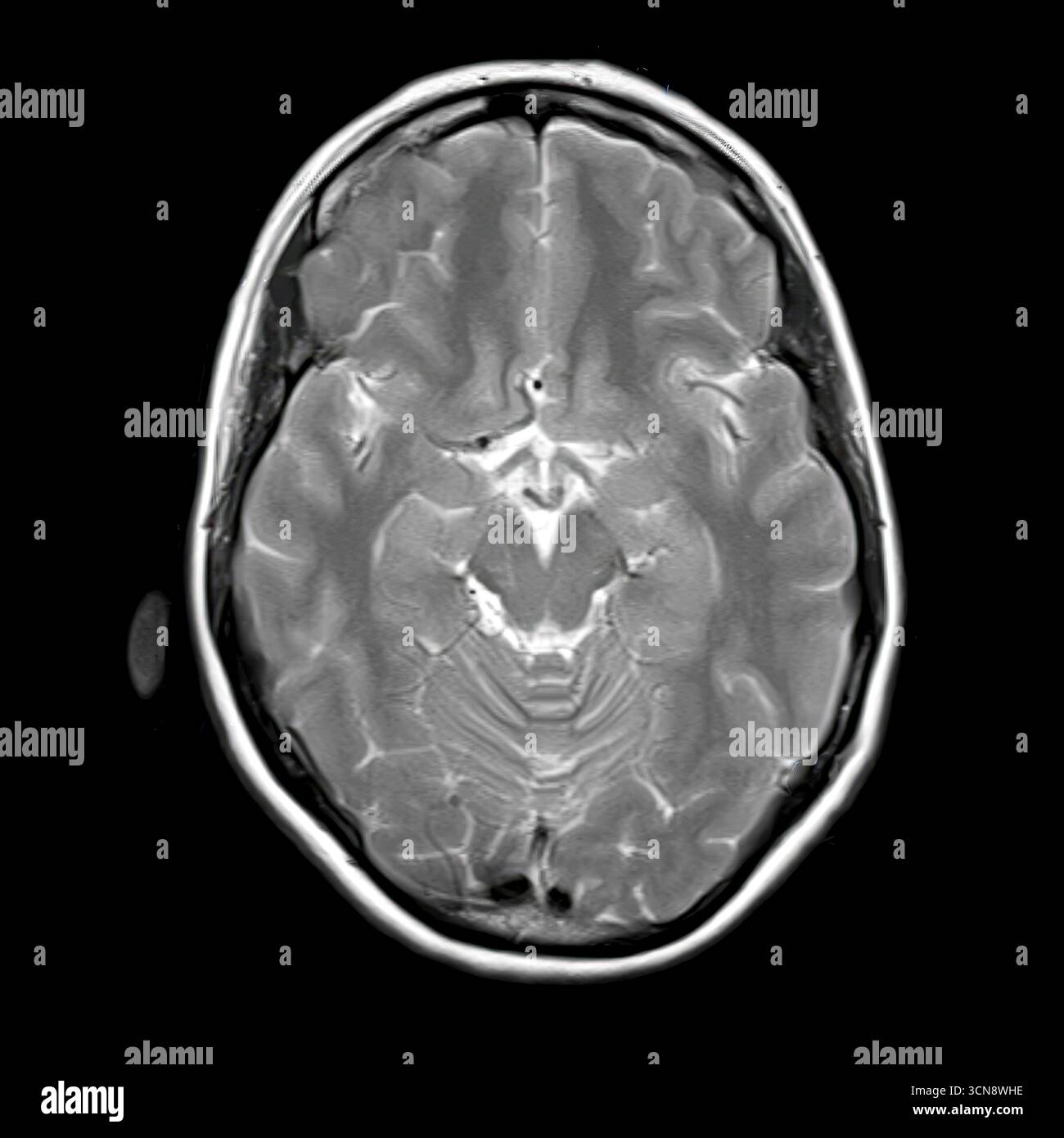 Imagerie par résonance magnétique (IRM) du cerveau humain montrant le mésencéphale et les parties supérieures du tronc cérébral impliquées dans le contrôle moteur, les voies sensorielles et les fonctions autonomes. Banque D'Images