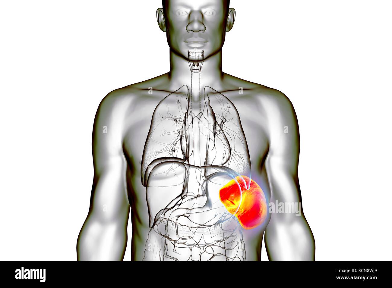 Splénomégalie. Illustration montrant une rate agrandie. Cela se produit dans les infections, la cirrhose du foie, la leucémie, le lymphome, le paludisme et les maladies auto-immunes. Banque D'Images