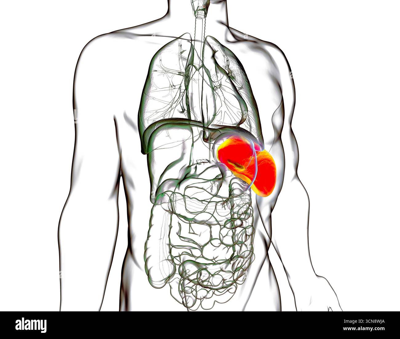 Splénomégalie. Illustration montrant une rate agrandie. Cela se produit dans les infections, la cirrhose du foie, la leucémie, le lymphome, le paludisme et les maladies auto-immunes. Banque D'Images