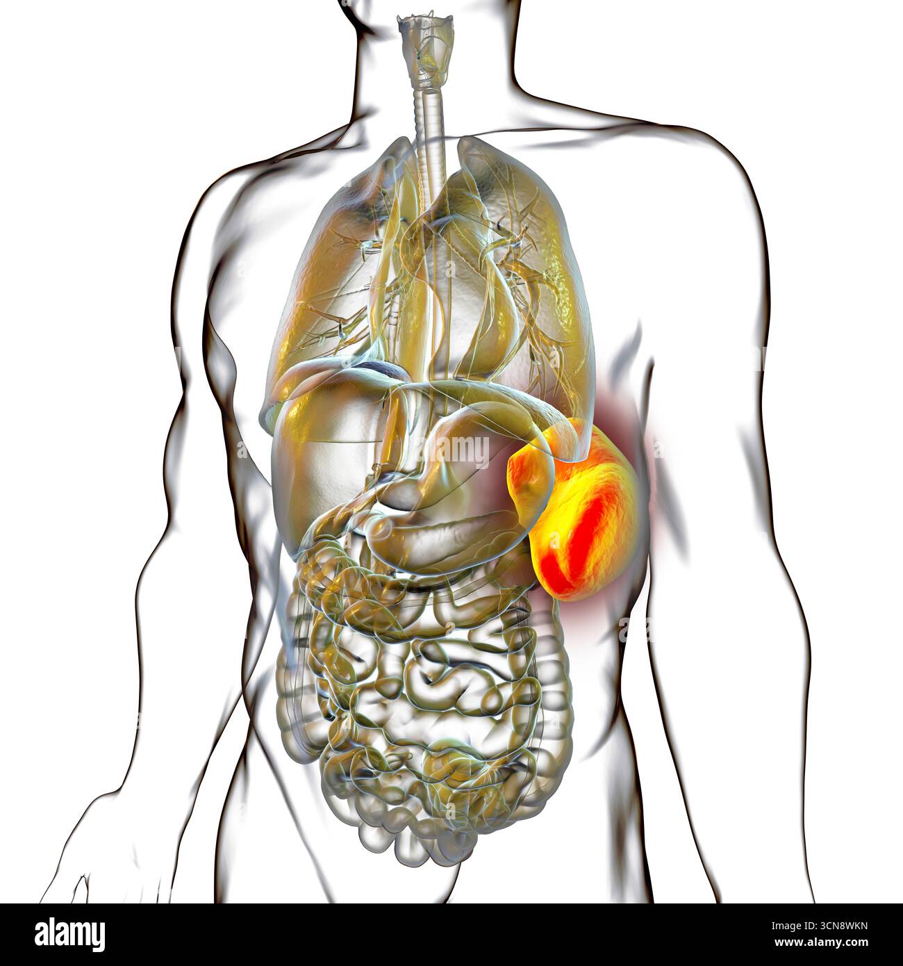 Splénomégalie. Illustration montrant une rate agrandie. Cela se produit dans les infections, la cirrhose du foie, la leucémie, le lymphome, le paludisme et les maladies auto-immunes. Banque D'Images