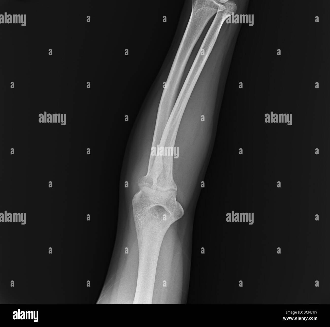 Radiographie des os de l'articulation du coude et de l'avant-bras de l'homme adulte sur fond noir. Rayon de l'image diagnostique médicale et cubitus pour l'analyse orthopédique Banque D'Images