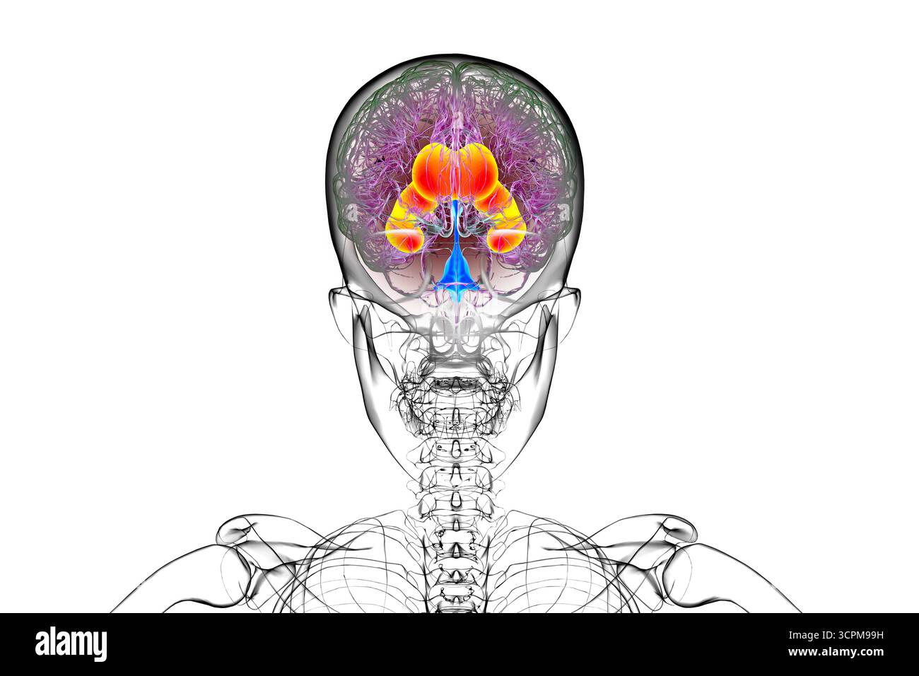 Ventricules latéraux élargis du cerveau (hydrocéphalie), illustration. Banque D'Images