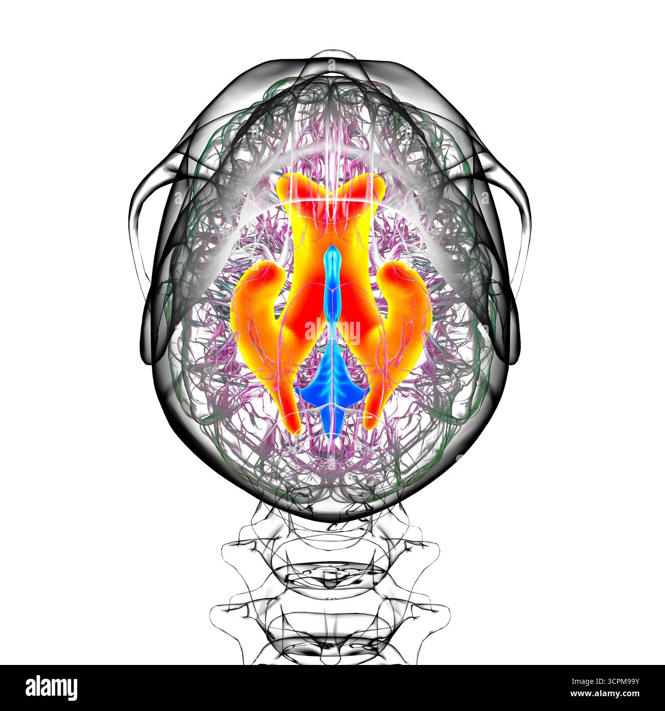Ventricules latéraux élargis du cerveau (hydrocéphalie), illustration. Banque D'Images