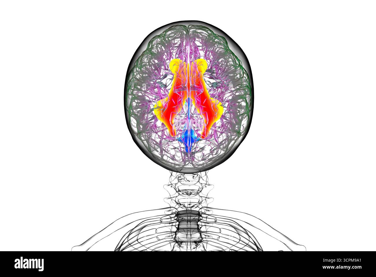Ventricules latéraux élargis du cerveau (hydrocéphalie), illustration. Banque D'Images