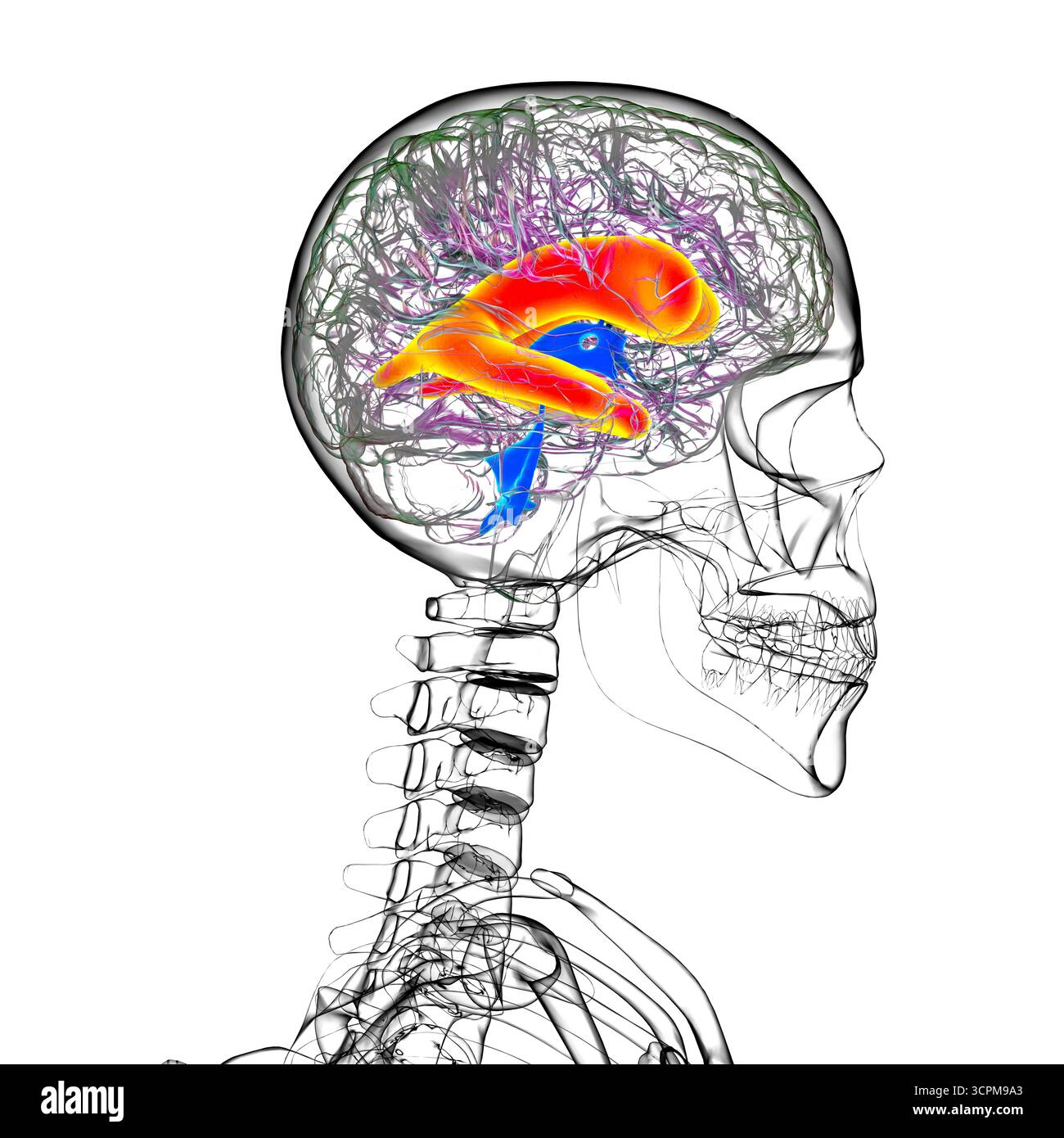 Ventricules latéraux élargis du cerveau (hydrocéphalie), illustration. Banque D'Images