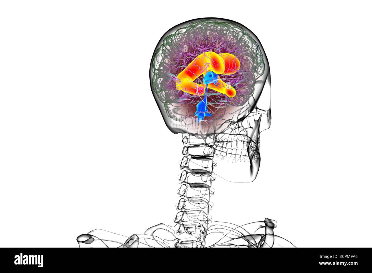 Ventricules latéraux élargis du cerveau (hydrocéphalie), illustration. Banque D'Images