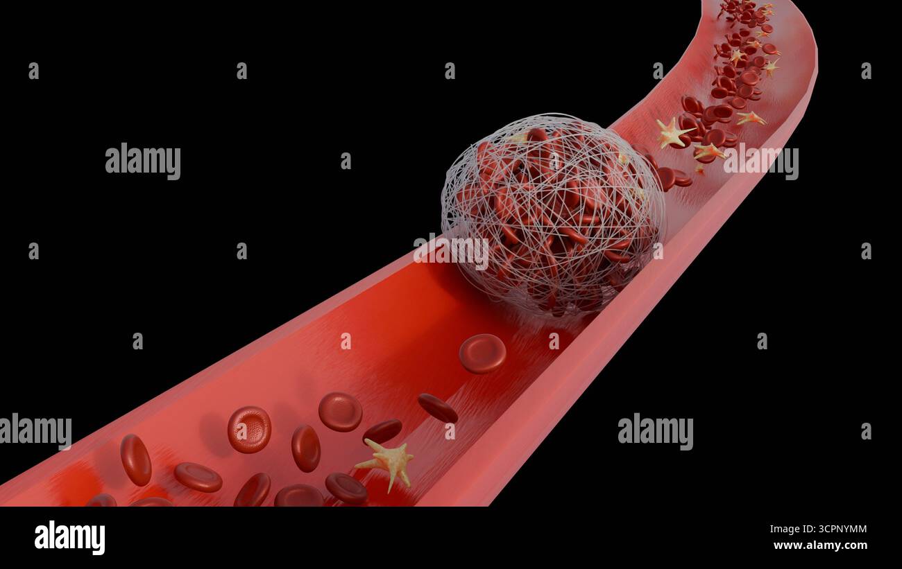 Image 3D de la formation d'un thrombus dans un vaisseau sanguin Banque D'Images
