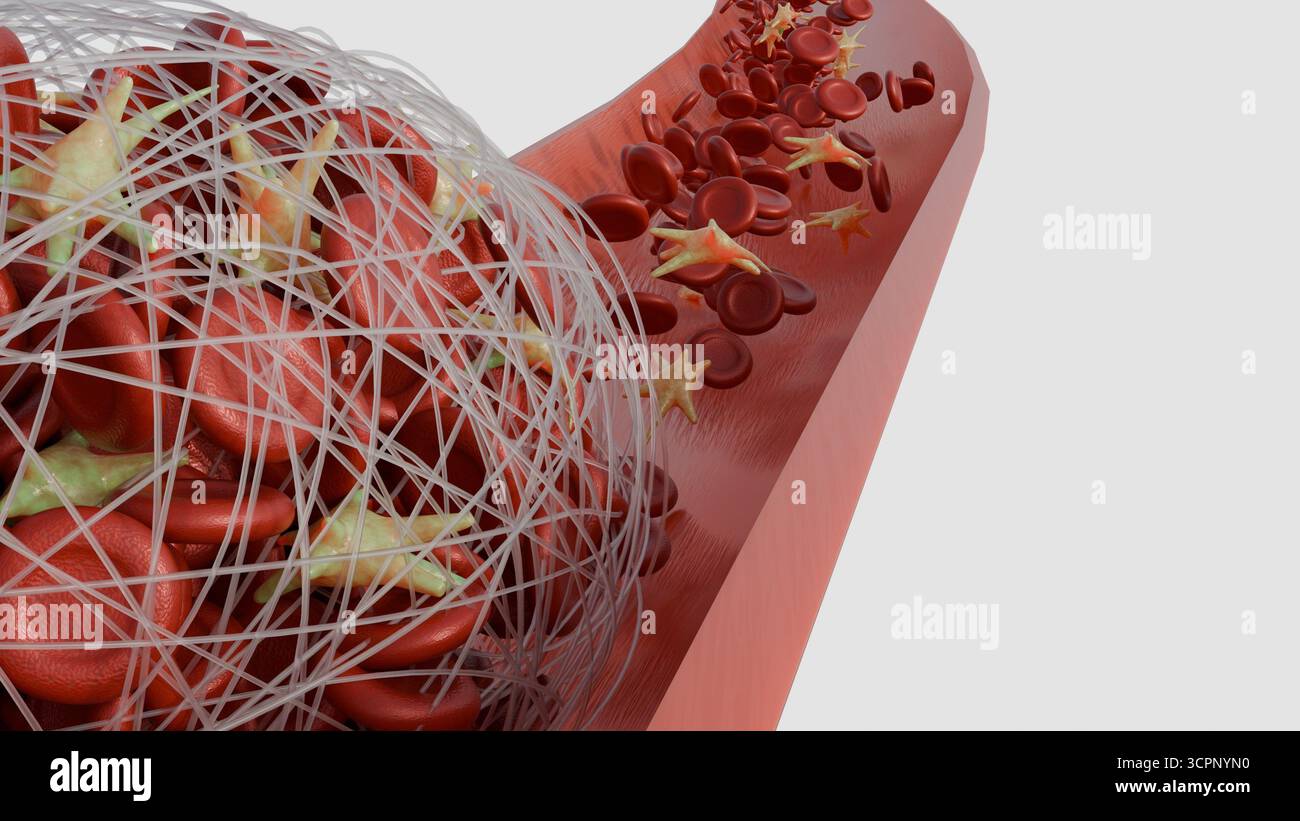 Image 3D de la formation d'un thrombus dans un vaisseau sanguin Banque D'Images
