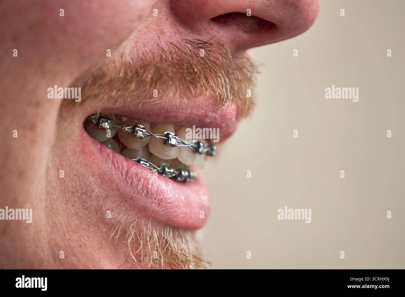 Sourire avec des appareils dentaires, vue de côté, gros plan. Homme adulte avec moustache rouge et barbe Banque D'Images