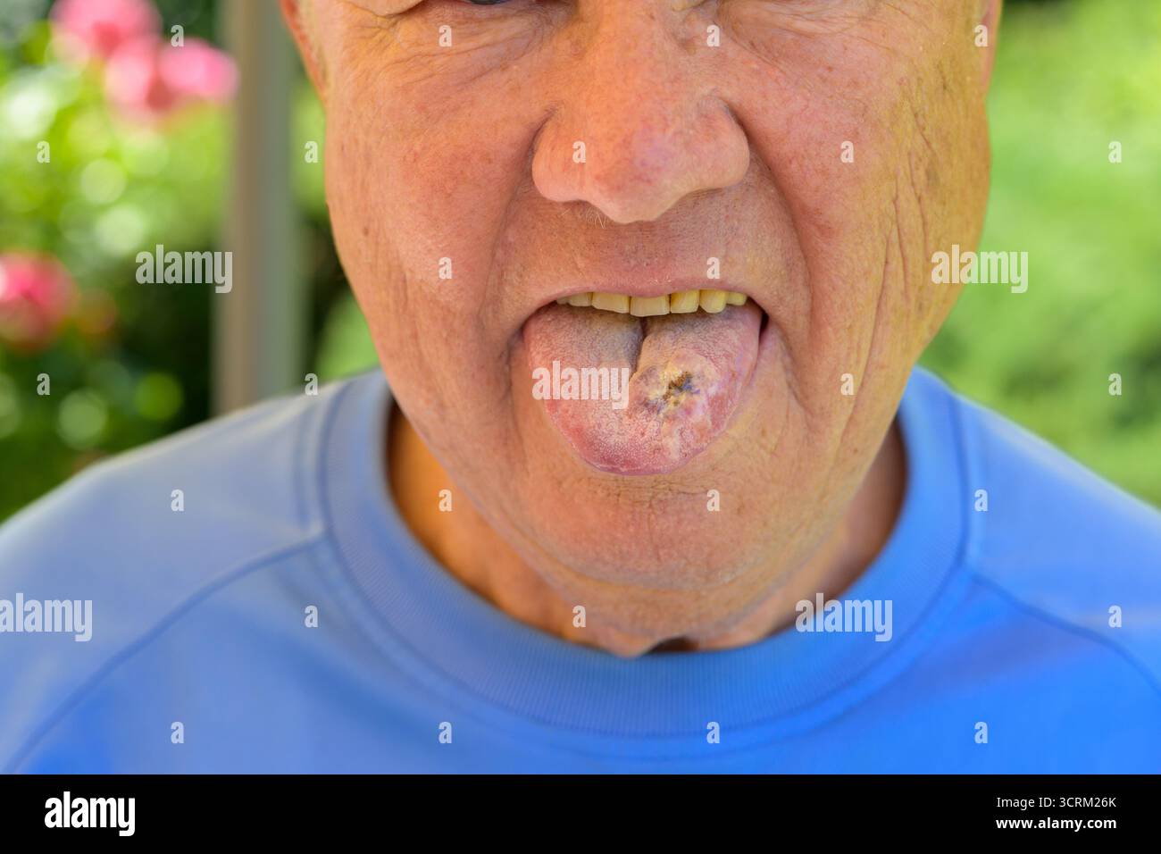 Gros plan d'un homme âgé montrant une langue avec lésion visible. Banque D'Images