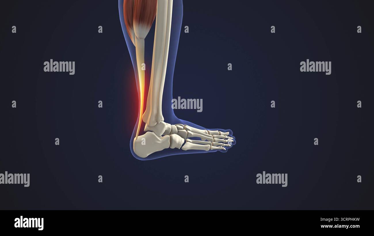 Inflammation du tendon d'Achille dans le pied Banque D'Images