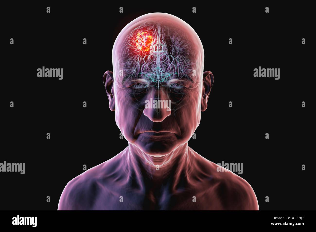Illustration d'une tumeur cérébrale chez une personne âgée. Une tumeur cérébrale est une masse de cellules anormales qui se développent dans le cerveau. Il existe plus de 130 types de tumeurs cérébrales primitives. Ils sont nommés selon le type de cellules ou la partie du cerveau dans laquelle ils commencent. Banque D'Images