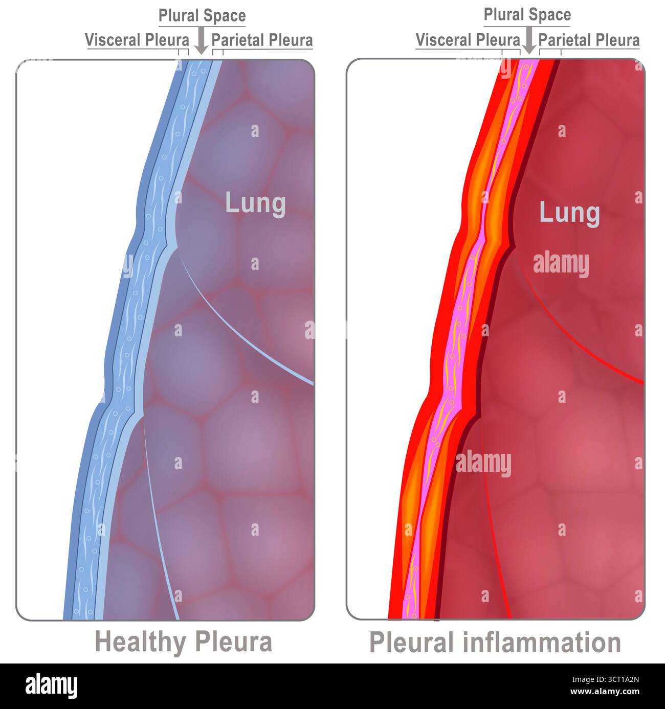 Illustration montrant les couches de la plèvre pulmonaire. L'un d'eux est atteint de pleurésie ou de pleurite. Cette inflammation se caractérise par une douleur aiguë et poignarante dans la poitrine, qui s’aggrave lors de la prise d’une respiration profonde, de la toux ou des éternuements. Les causes sont variées et incluent des infections virales ou bactériennes. Banque D'Images