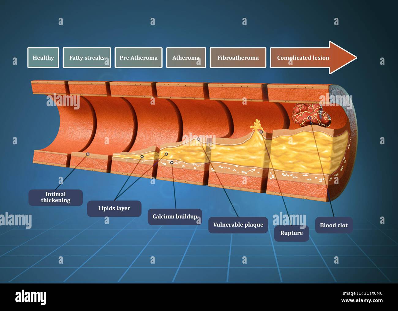 Les étapes impliquées dans l'athérosclérose des vaisseaux sanguins humains. Illustration numérique, rendu 3D. Banque D'Images