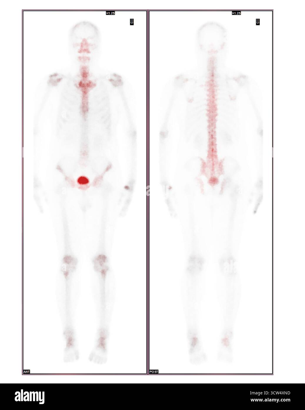 La scintigraphie osseuse du corps entier a été réalisée après injection intraveineuse de Tc-99m MDP ne montrant aucune preuve certaine de métastase osseuse. Banque D'Images