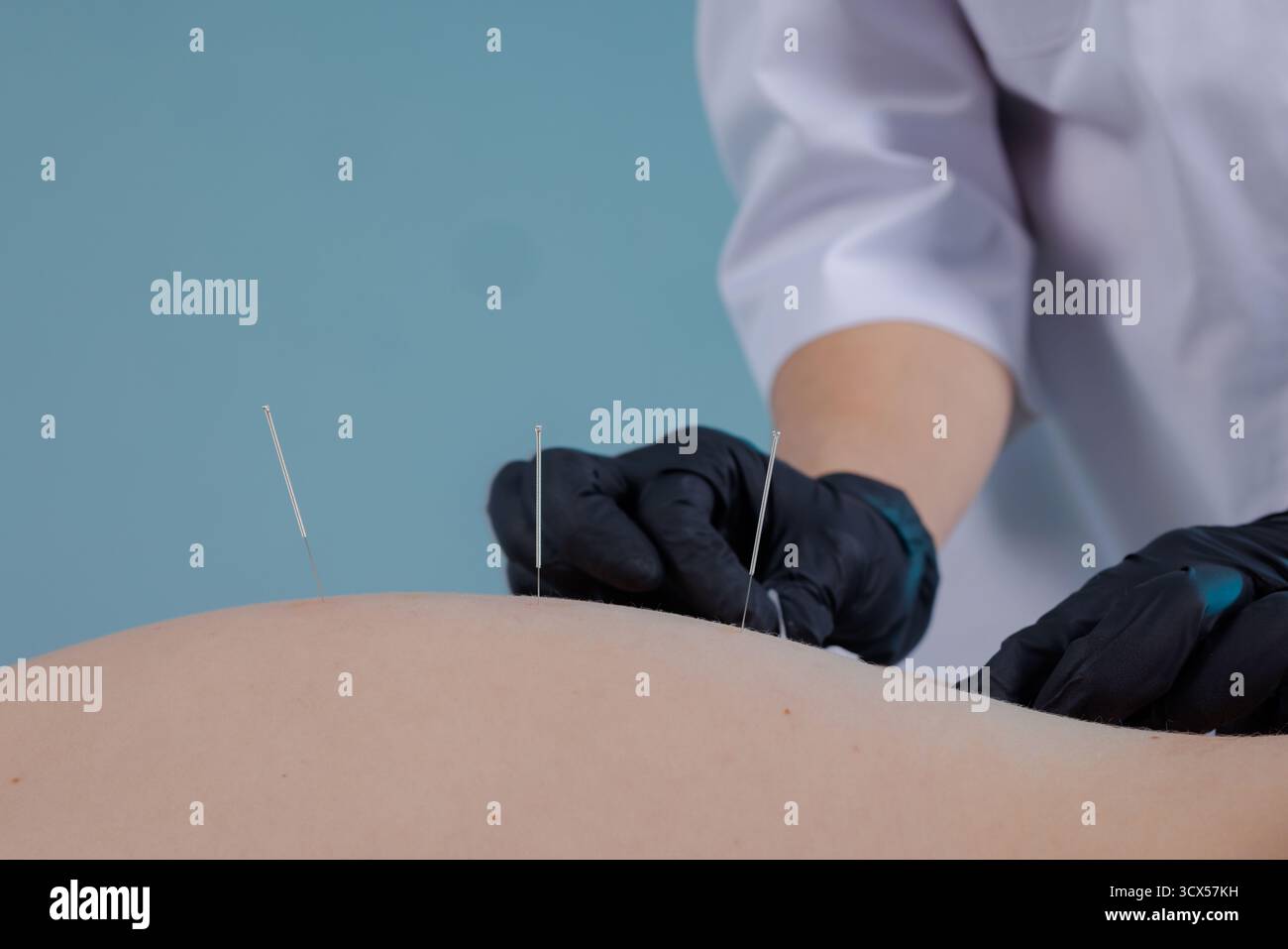 Vue rapprochée de l'acupuncture à l'aiguille sèche sur le dos avec des gants stériles et des aiguilles fines, parfait pour le bien-être, la réadaptation, l'éditorial et l'éducation clinique. Banque D'Images