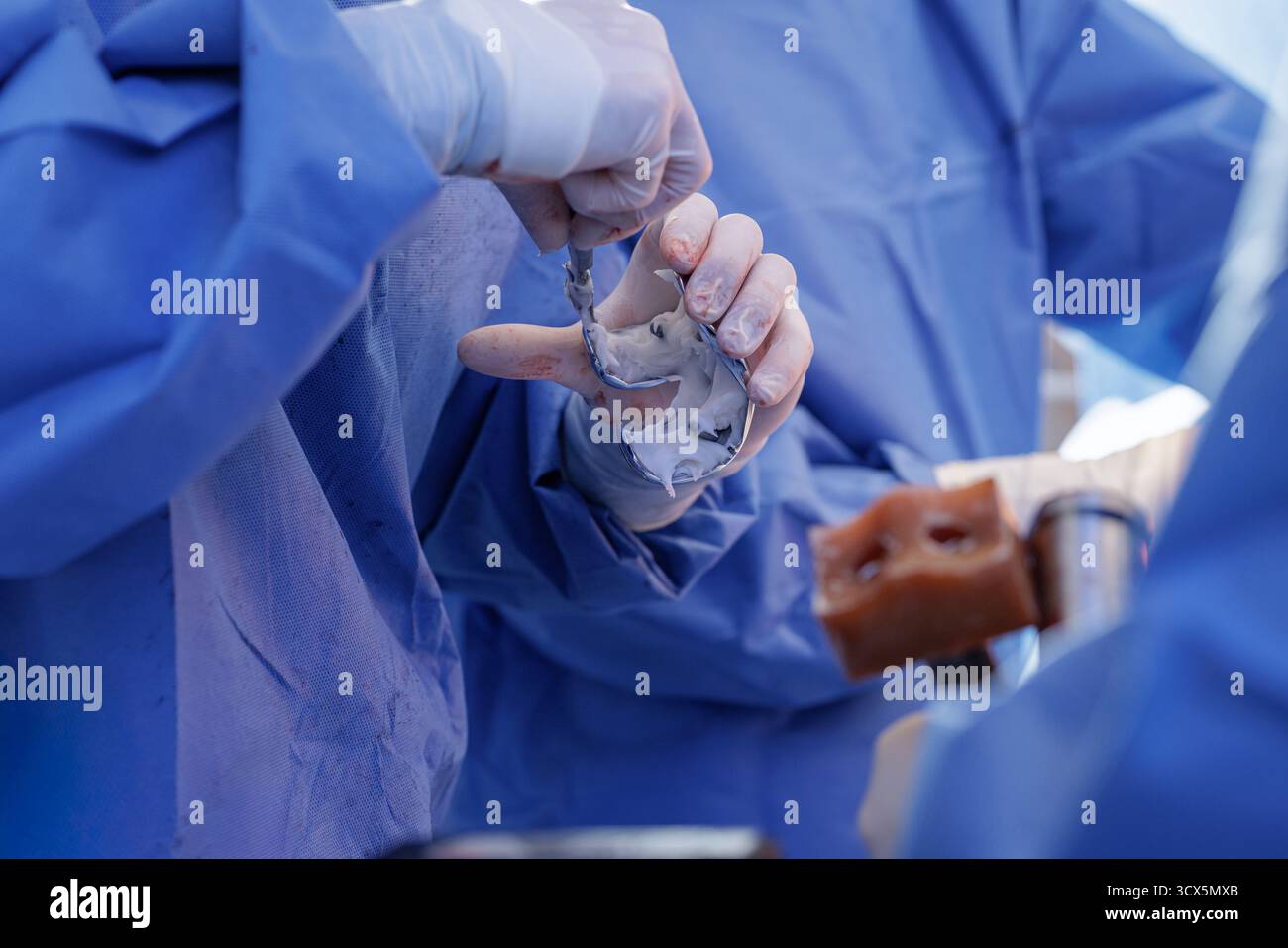 Chirurgien ganté appliquant du ciment osseux PMMA sur une prothèse fémorale de genou au cours d'une arthroplastie moderne en salle d'opération stérile. Banque D'Images