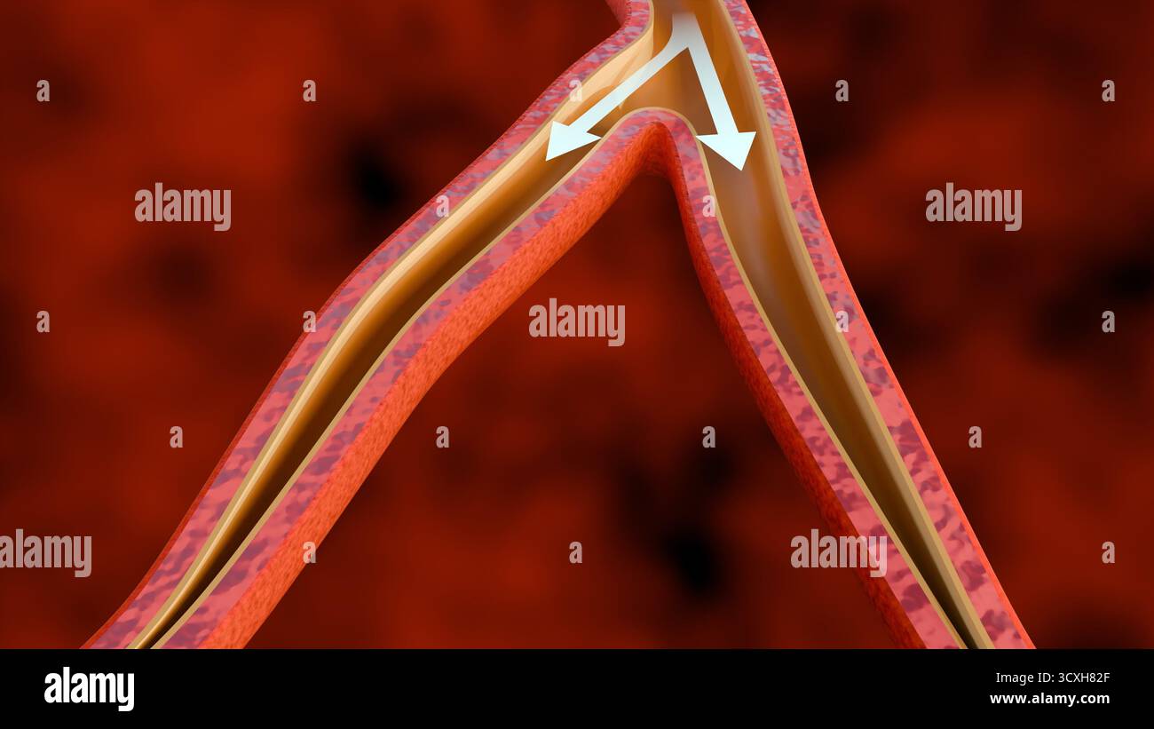 Illustration médicale en 3D d'une constriction vasculaire avec des flèches blanches indiquant une circulation sanguine réduite et entravée. Banque D'Images