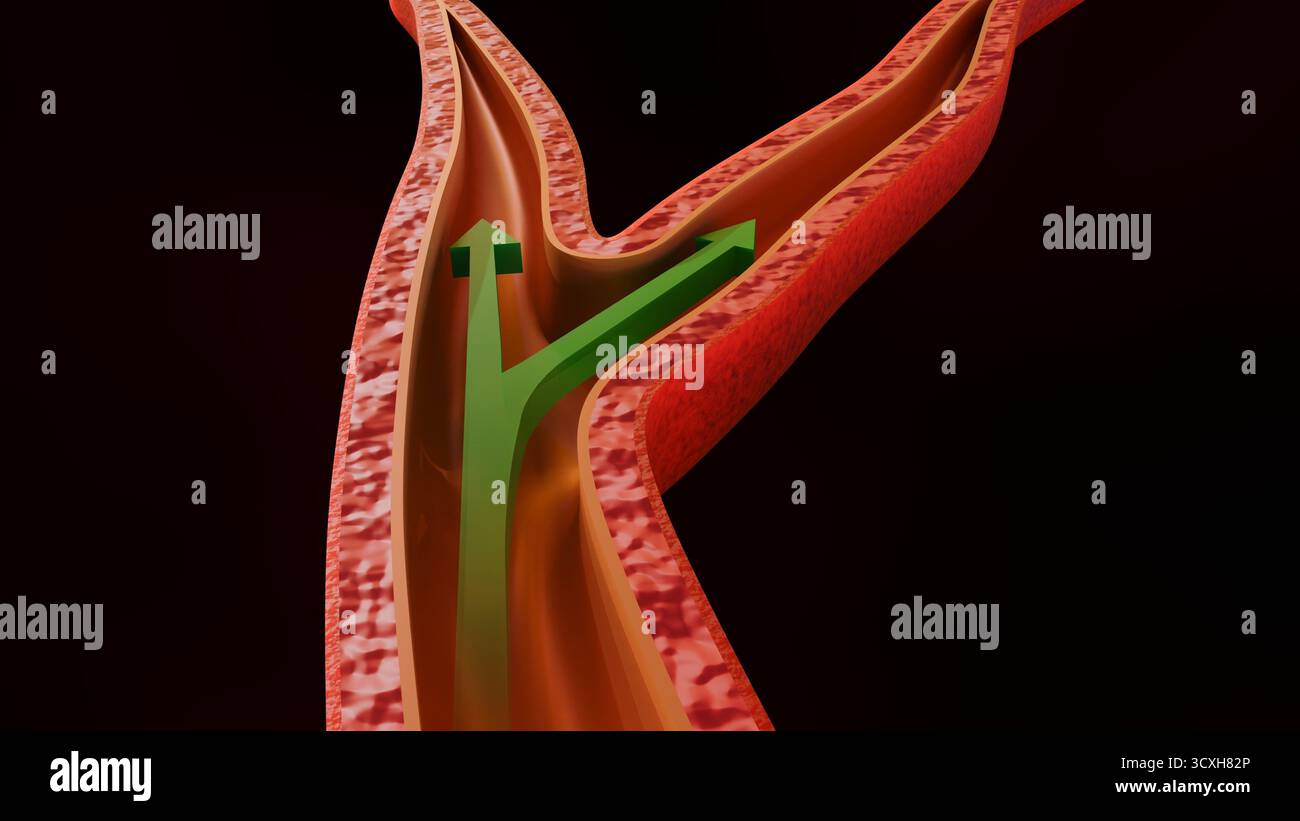 Illustration médicale en 3D d'une constriction vasculaire avec des flèches blanches indiquant une circulation sanguine réduite et entravée. Banque D'Images