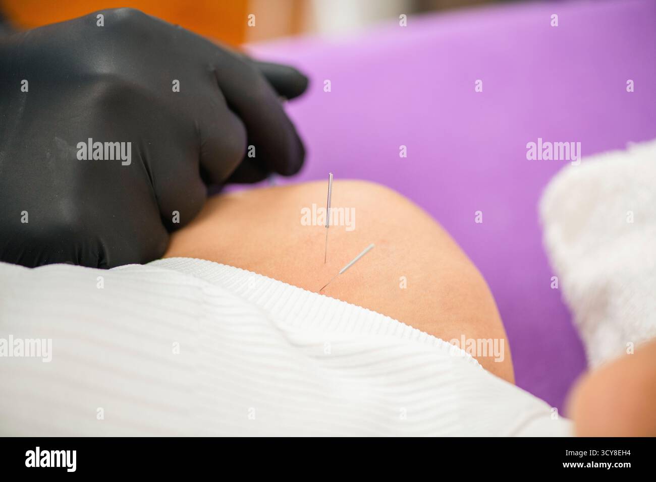 Femme recevant un traitement d'aiguilletage sec sur son épaule pendant une séance de physiothérapie. Le traitement cible la tension musculaire, le soulagement de la douleur et améliore la mobilité pour la rééducation. Banque D'Images