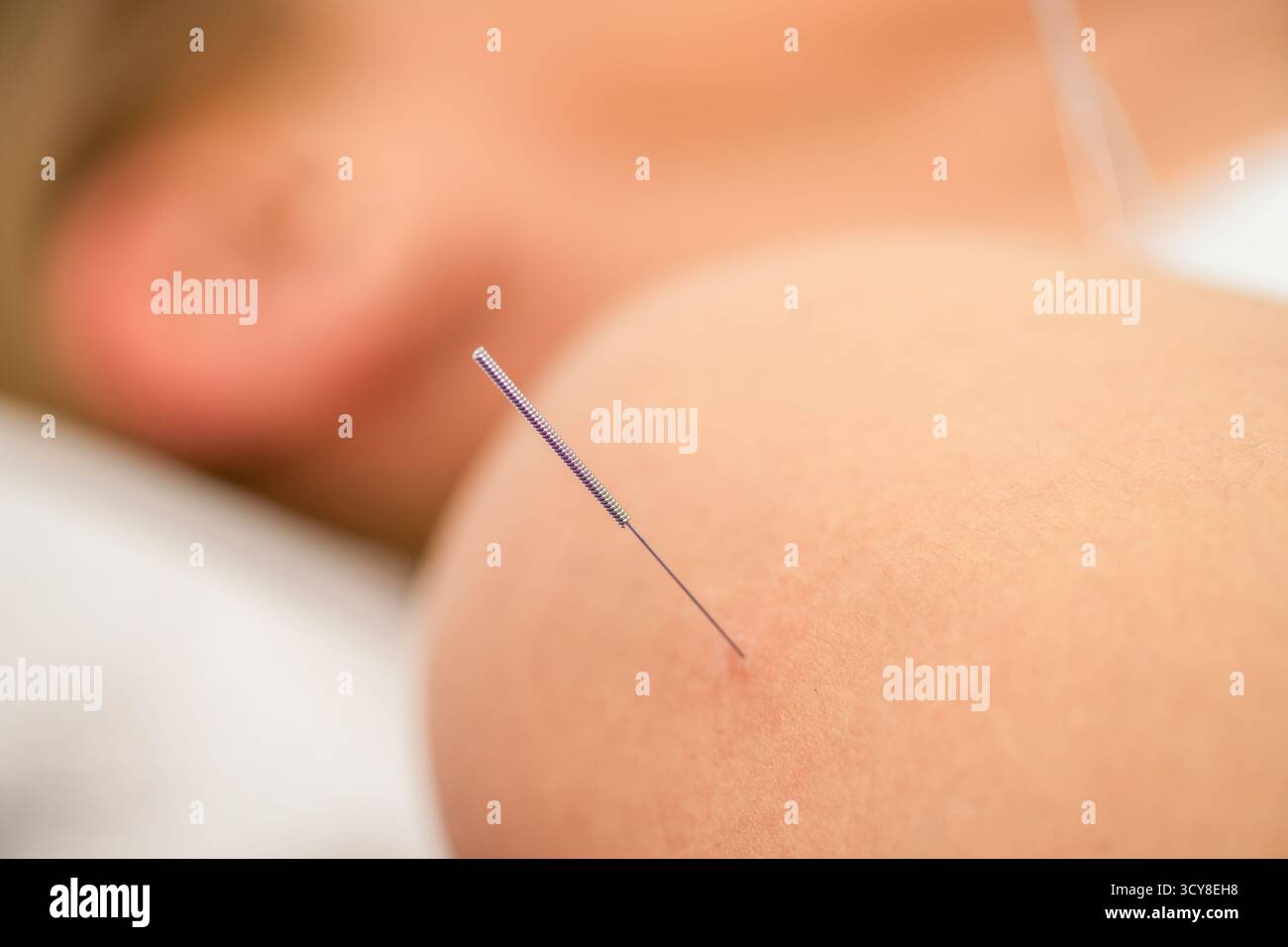 Femme recevant un traitement d'aiguilletage sec sur son épaule pendant une séance de physiothérapie. Le traitement cible la tension musculaire, le soulagement de la douleur et améliore la mobilité pour la rééducation. Banque D'Images