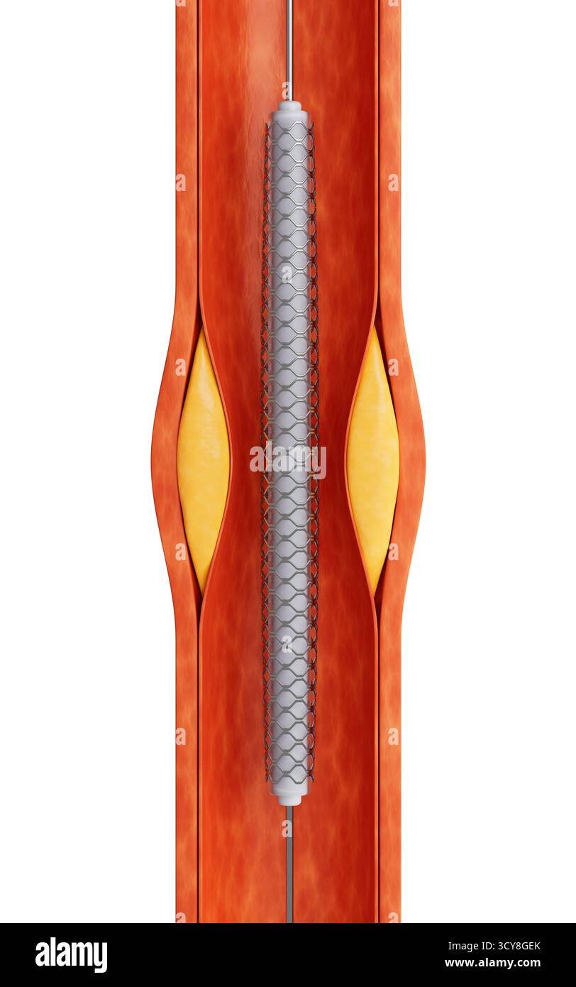 Vaisseau sanguin avec stent coronaire, rendu 3D. Illustration 3D. Banque D'Images