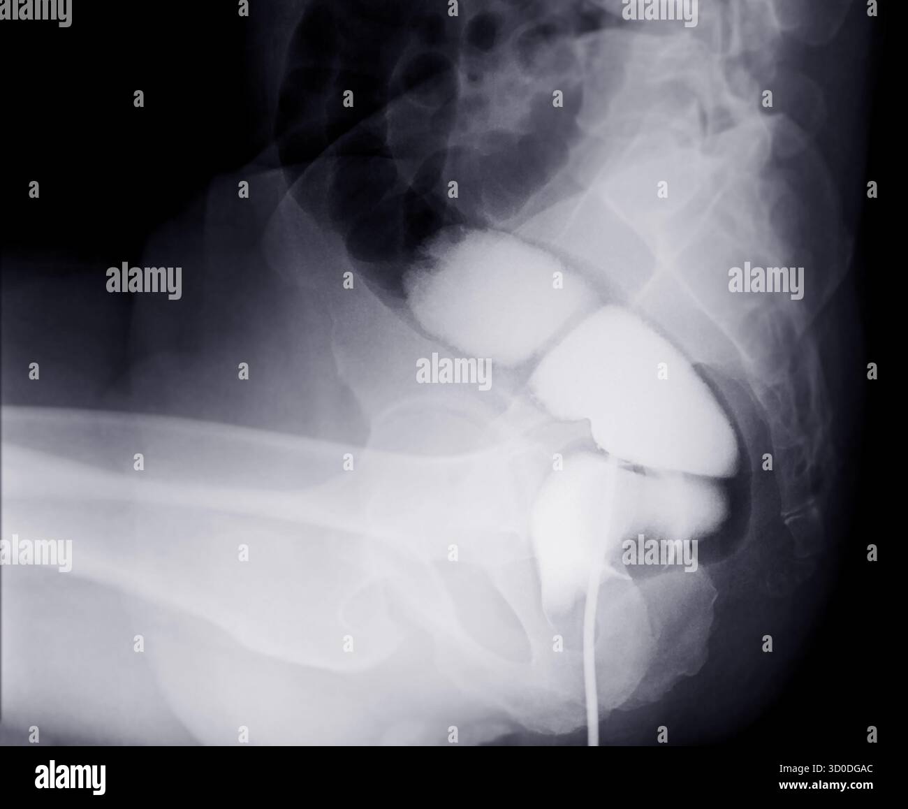 Une image diagnostique de lavement baryté montrant la présence de diverticulose dans le côlon transverse et ascendant, démontrant le diverticulaire typique f Banque D'Images