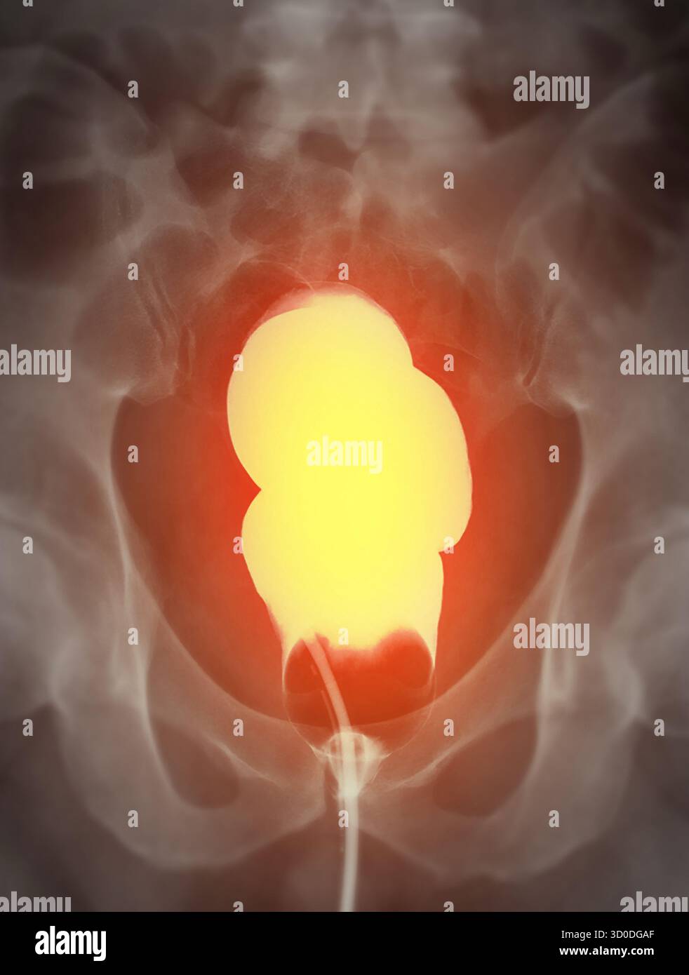 Une image diagnostique de lavement baryté montrant la présence de diverticulose dans le côlon transverse et ascendant, démontrant le diverticulaire typique f Banque D'Images