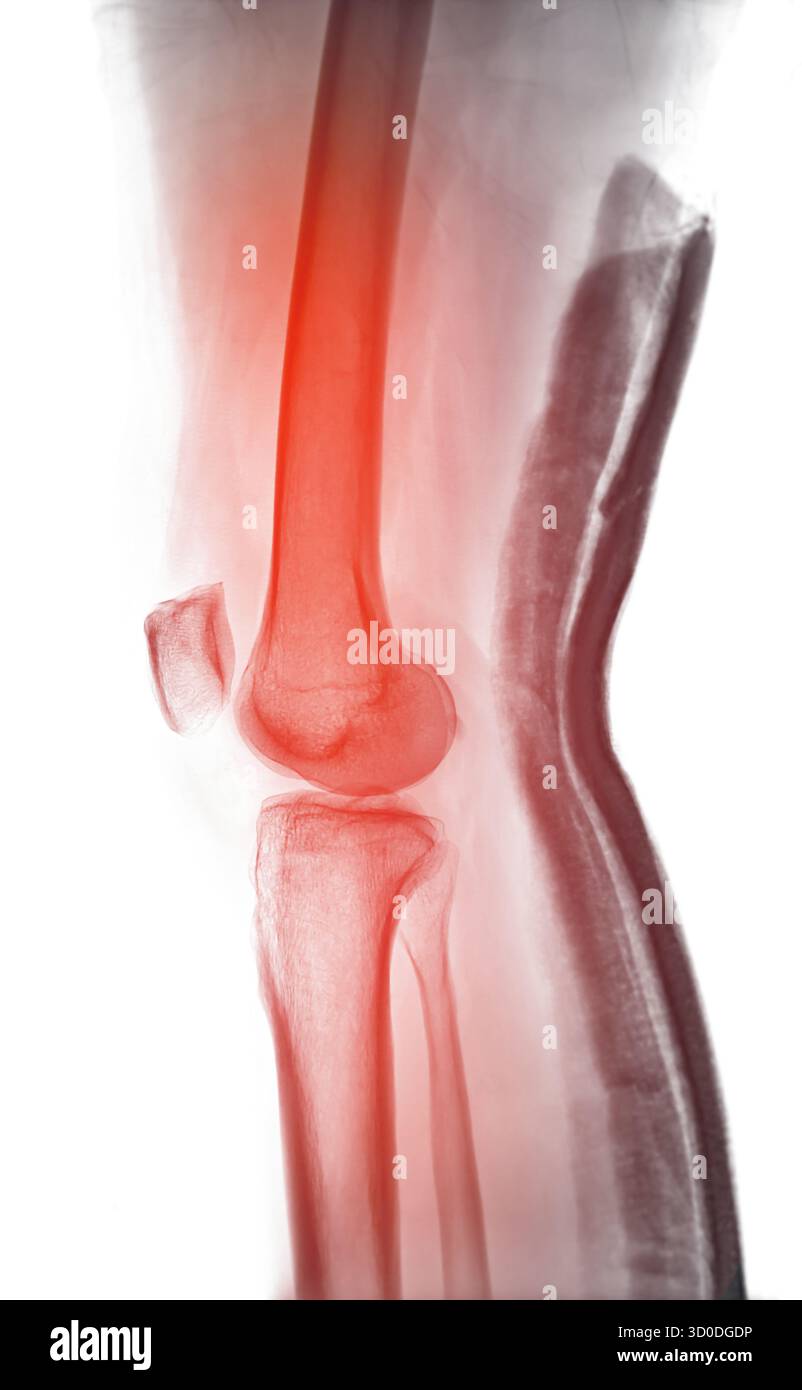 Image radiographique révélant une fracture du fémur dans le genou, avec une attelle appliquée pour maintenir l'alignement osseux pour une récupération correcte. Banque D'Images Image radiographique révélant une fracture du fémur dans le genou, avec une attelle appliquée pour maintenir l'alignement osseux pour une récupération correcte. Banque D'Images