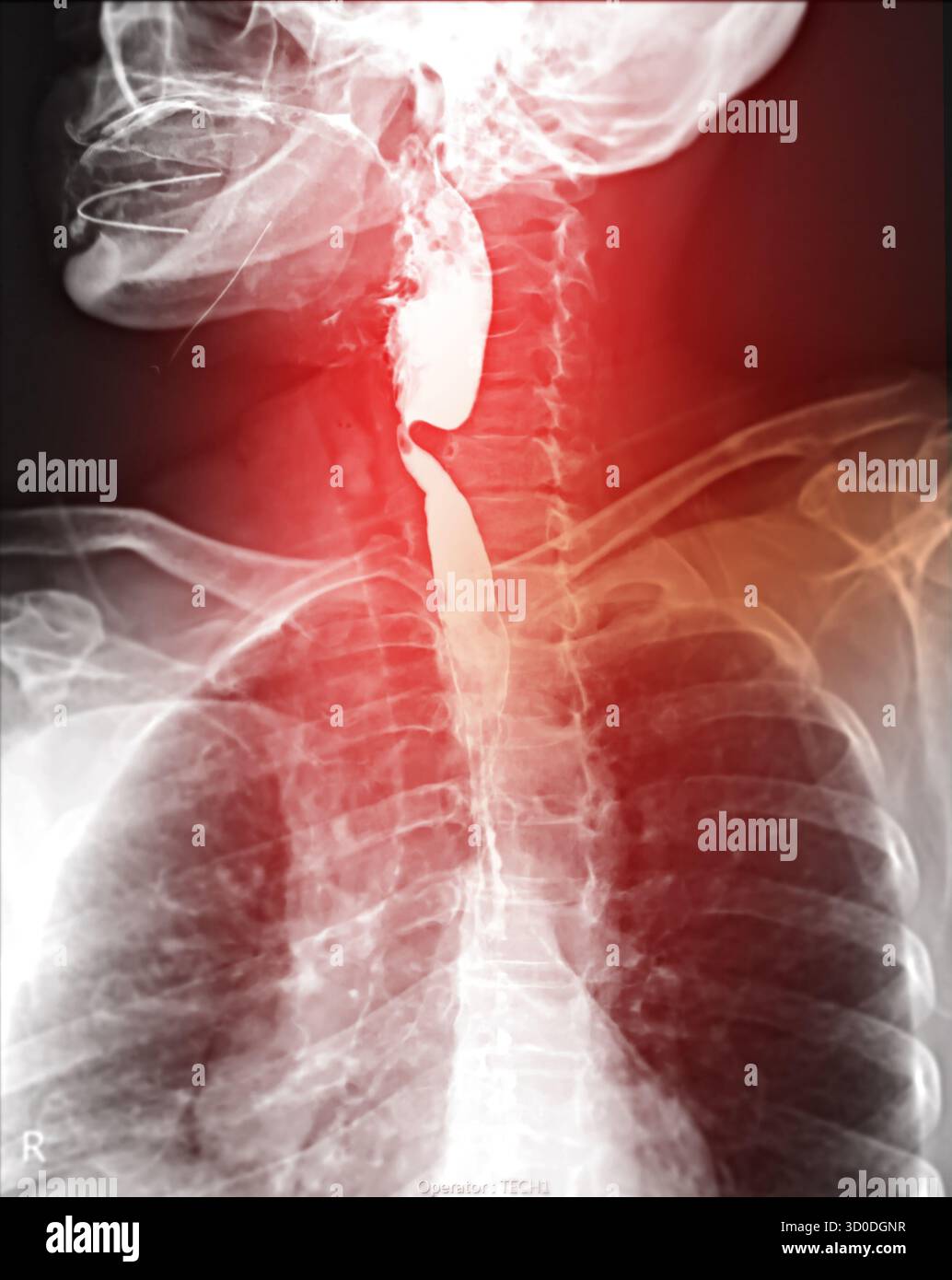 Radiographie de l'œsophage supérieur, montrant une fonction de déglutition normale sans signe d'obstruction ou d'anomalie dans la région de la gorge. Banque D'Images