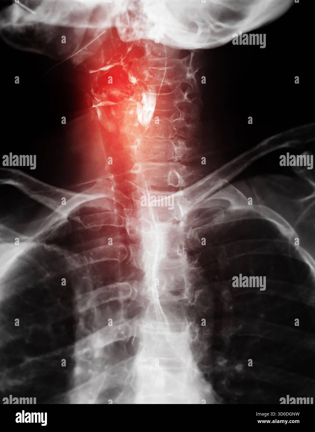 Radiographie de l'œsophage supérieur, montrant une fonction de déglutition normale sans signe d'obstruction ou d'anomalie dans la région de la gorge. Banque D'Images